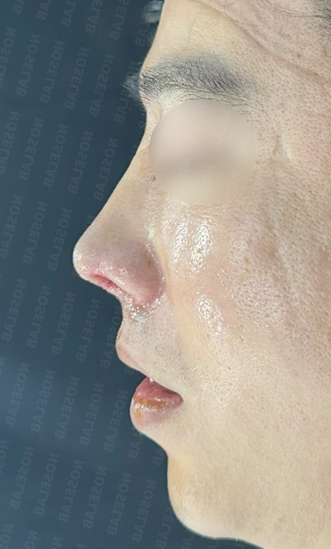코끝 염증을 겪은 뒤 콧날개가 찝히고 코끝이 꺼지는 이유와 재건 방법 — 수술 직후 0일 정면, 측면, 비스듬한 측면 사진 직후 사진은 부기가 있는 상태로 최종 결과와 다를 수 있습니다.