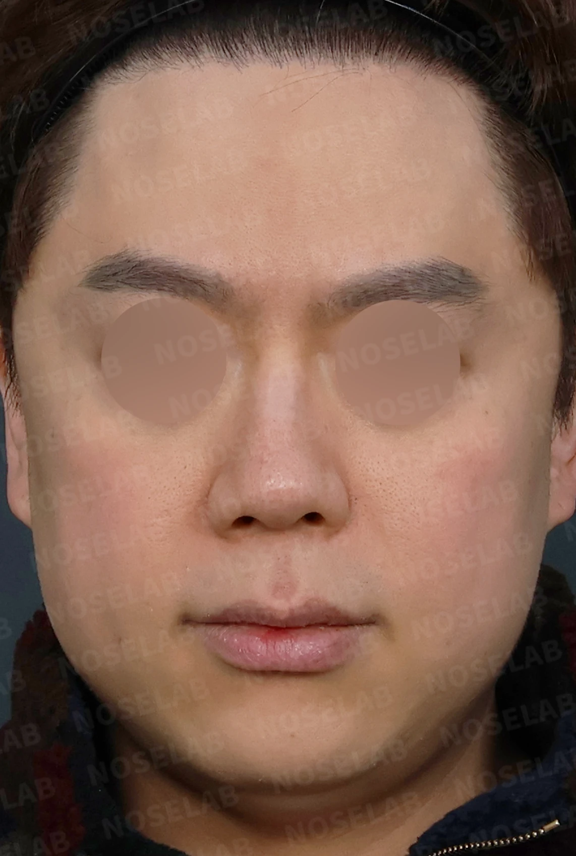 휘어진 매부리코, 자가늑연골로 교정한 남자 코성형 사례 — 디자인 상담 정면, 좌측 측면, 비스듬한 측면 입니다.