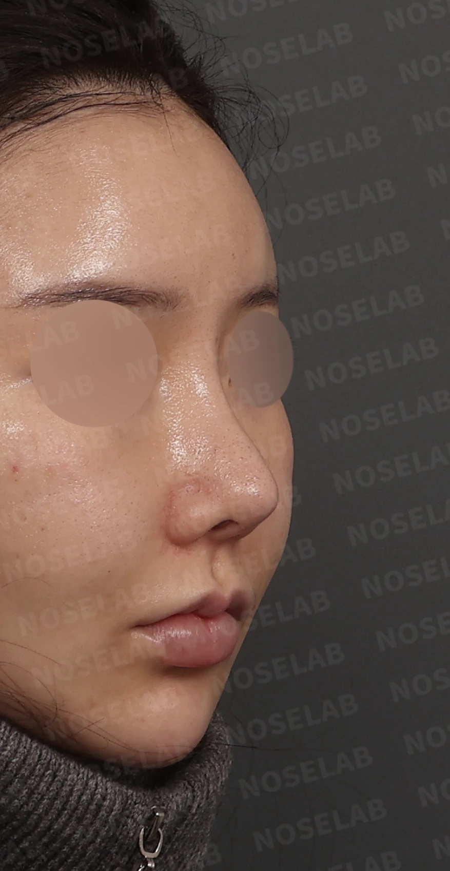 휘어진 코와 비공 비대칭, 자가늑연골 비중격 재건으로 완성한 코재수술 — 디자인 상담 우측 측면, 비스듬한 측면, 비공 사진