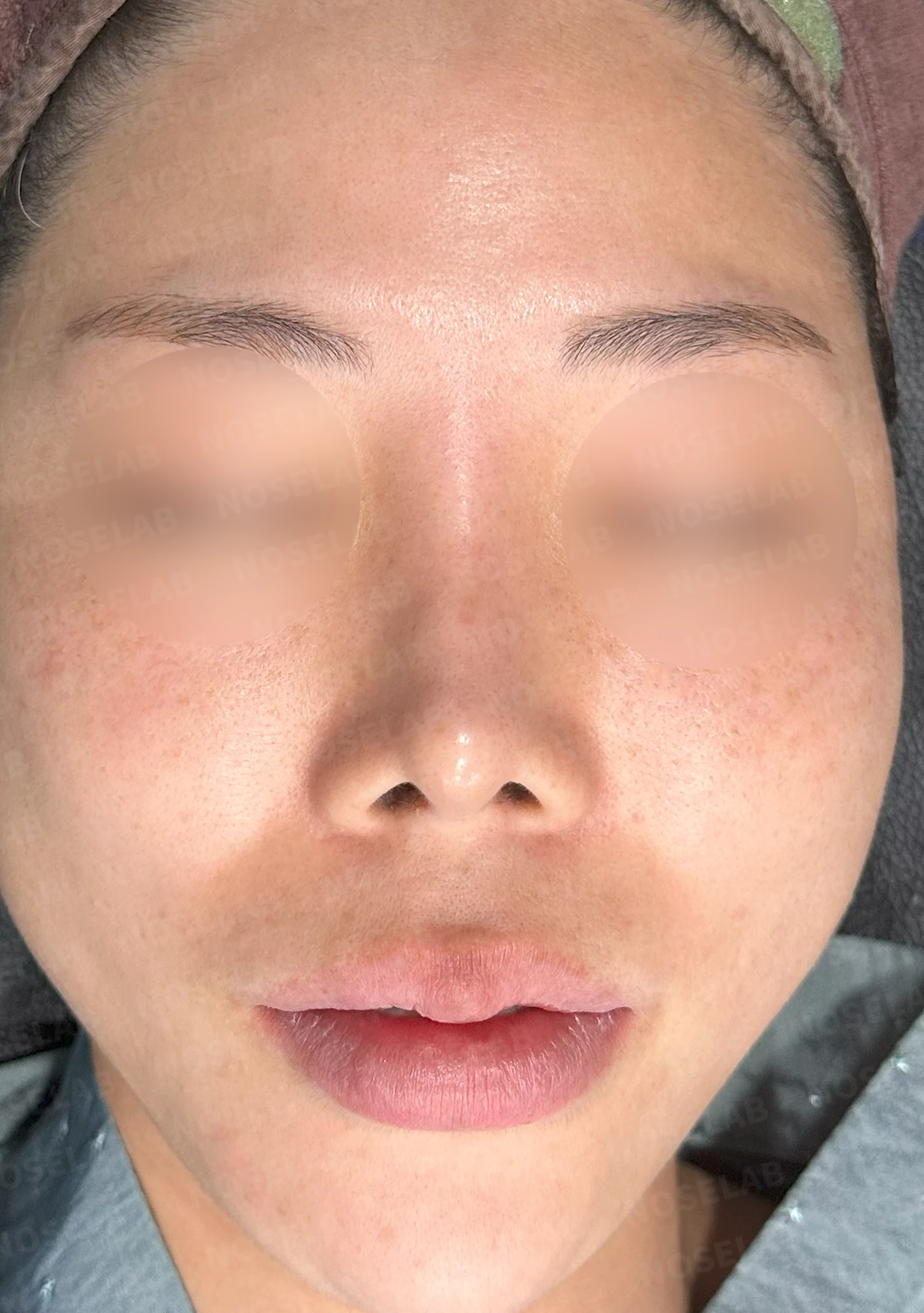 자연스러운 아름다움의 비밀: 들린코와 콧구멍 노출 교정 사례 — 수술전(좌) 수술직후(우)