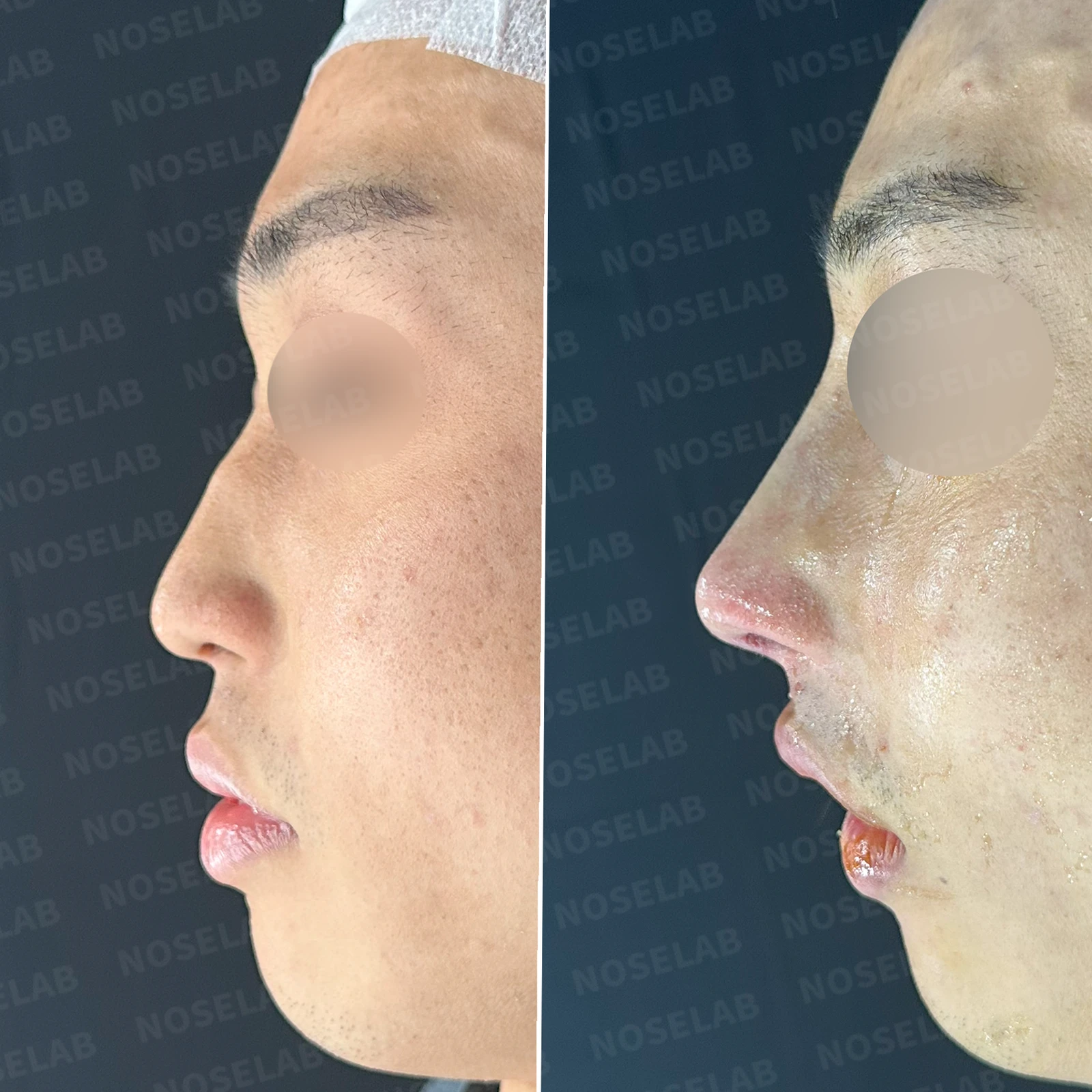 비염 수술 뒤에도 증상이 재발하는 이유, 휜 코를 함께 교정하는 방법 — 본문 사진 21