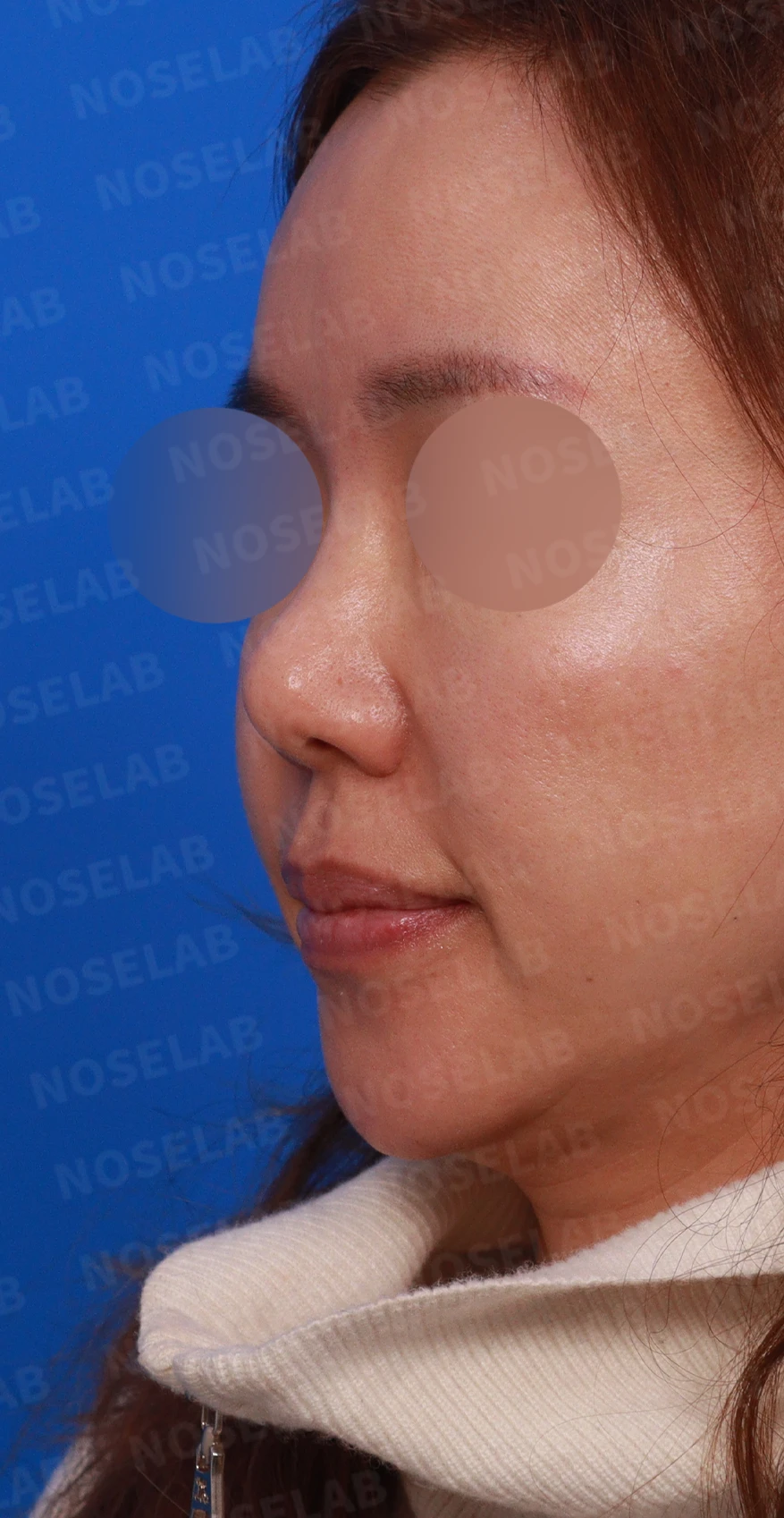 보형물을 제거한 뒤 콧대가 꺼지고 퍼지는 이유, 재건은 어떻게 하나 — 디자인 상담 정면, 좌측 측면, 비스듬한 측면 사진