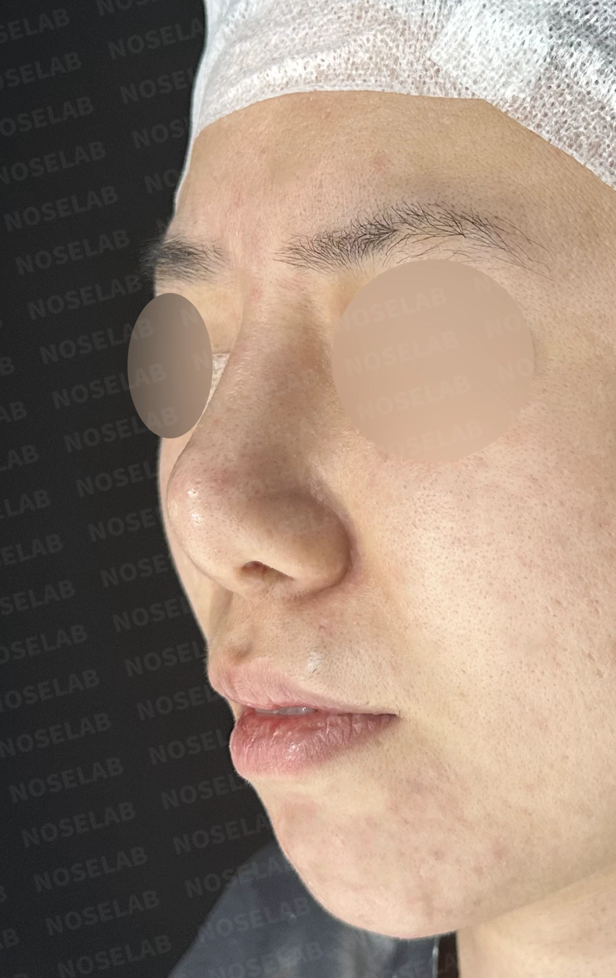 이전 수술 뒤 코가 딱딱해지고 짧아지는 구축, 왜 생기고 어떻게 재건하나 — 수술 전 / 수술 직후 0일 직후 사진은 부기가 있는 상태로 최종 결과와 다를 수 있습니다.
