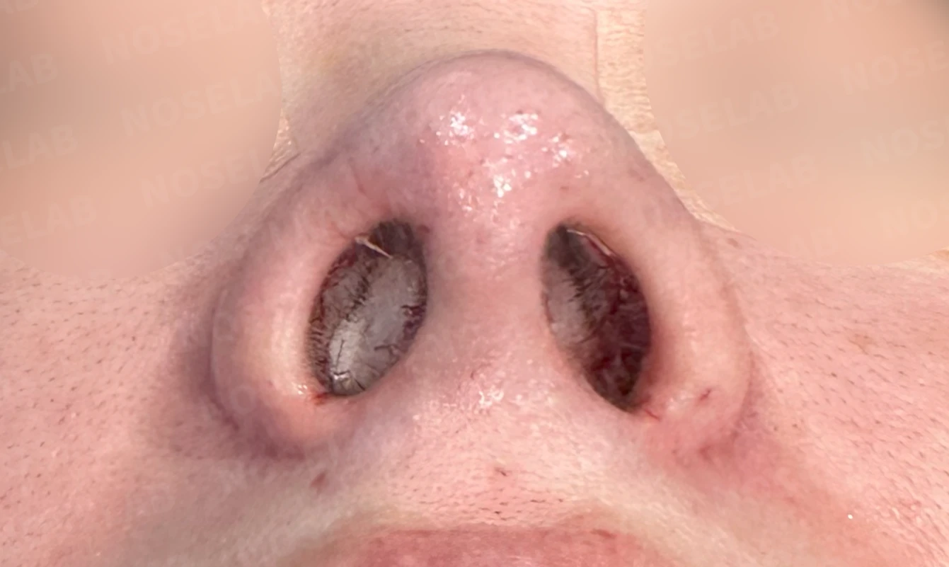 퍼진코, 복코 교정으로 균형 잡힌 이미지 완성 — 전(좌) 직후(우)
