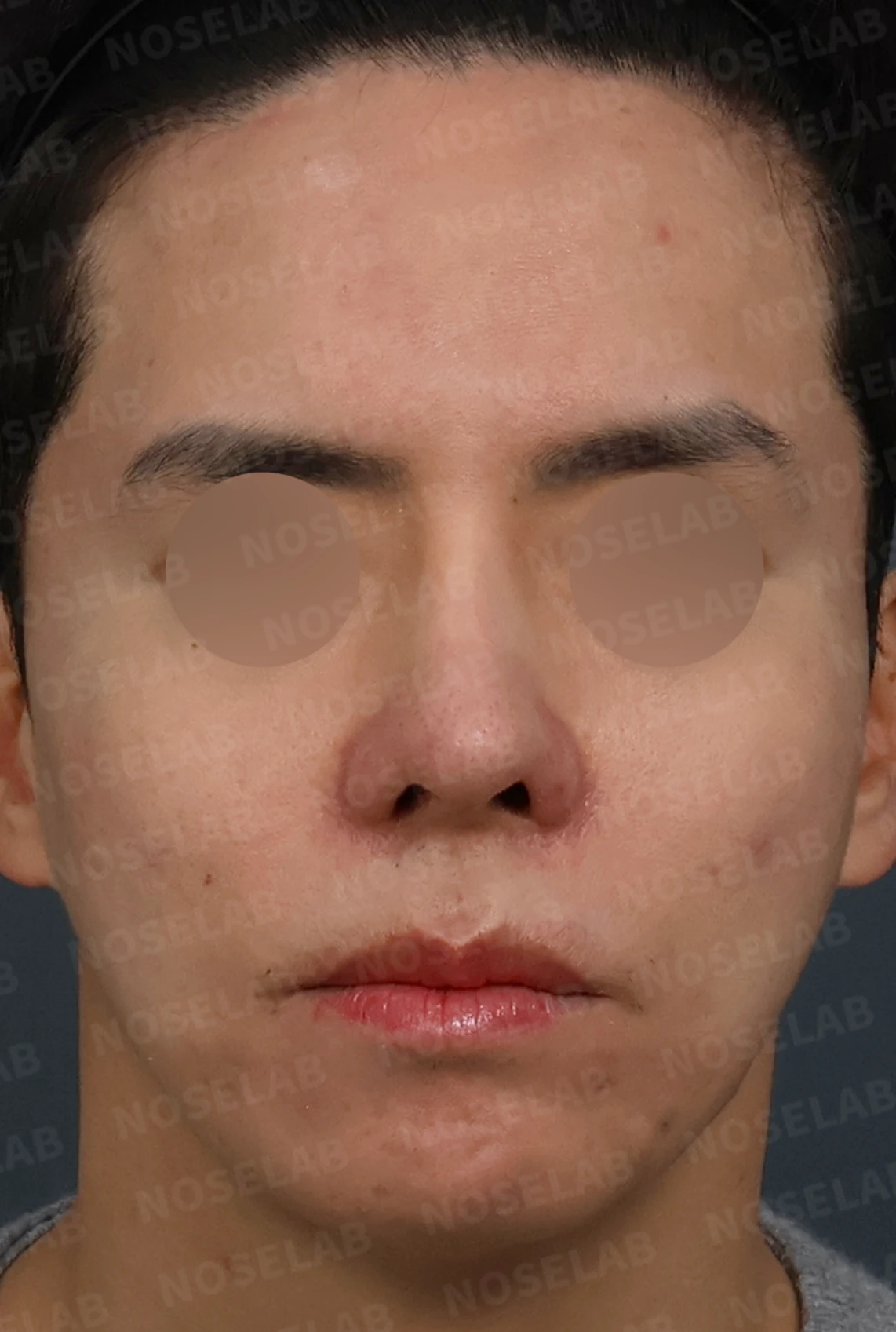 코재수술과 코막힘 교정, 기능과 심미 모두 잡은 비개방 코성형 사례 — 디자인 상담 정면, 좌측 측면, 비스듬한 측면 사진입니다.