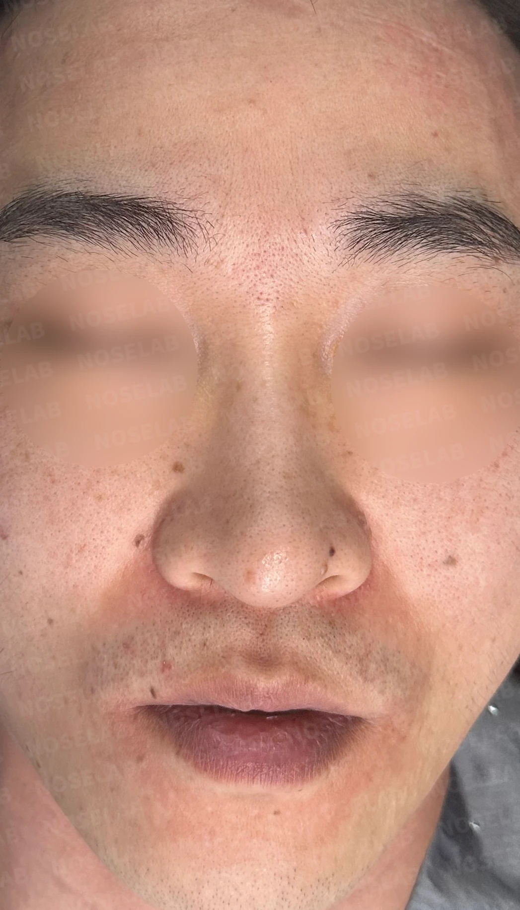 화살코, 휜코 교정 방법 — 수술 전 / 수술 직후 0일 직후 사진은 부기가 있는 상태로 최종 결과와 다를 수 있습니다.