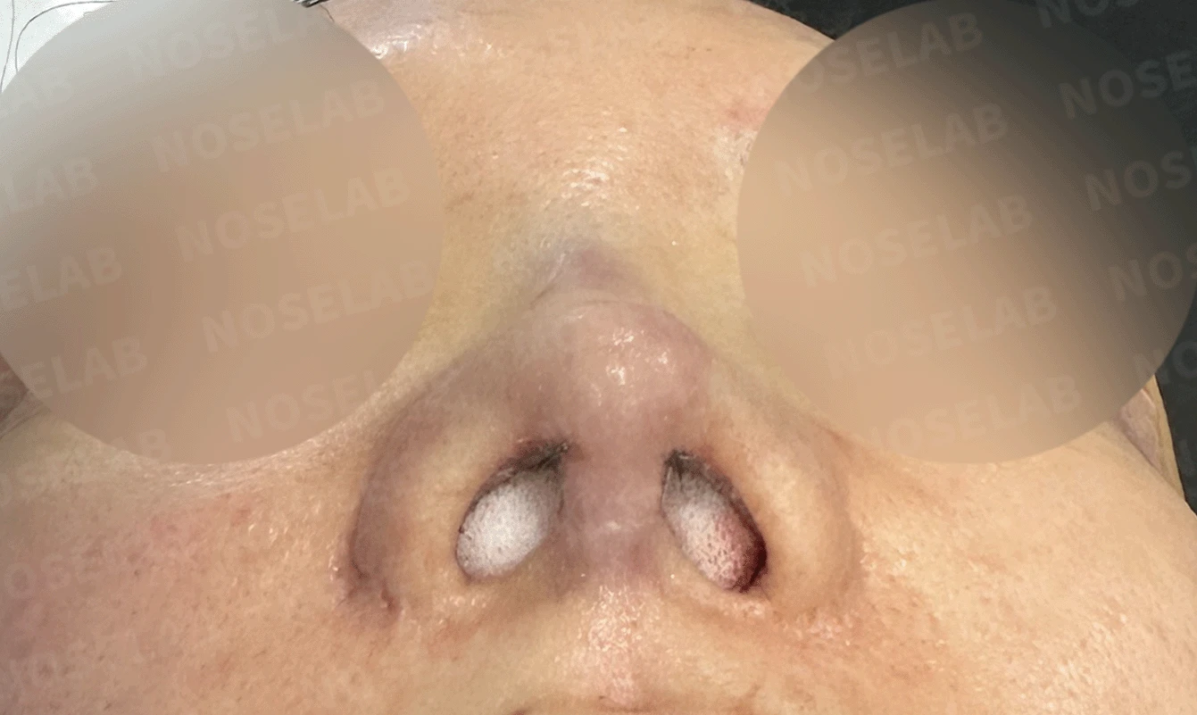 여러 차례 재수술로 코에 쓸 연골이 남지 않았을 때, 재건은 어떻게 하나 — 수술 직후 0일 비공 사진입니다. 직후 사진은 부기가 있는 상태로 최종 결과와 다를 수 있습니다.
