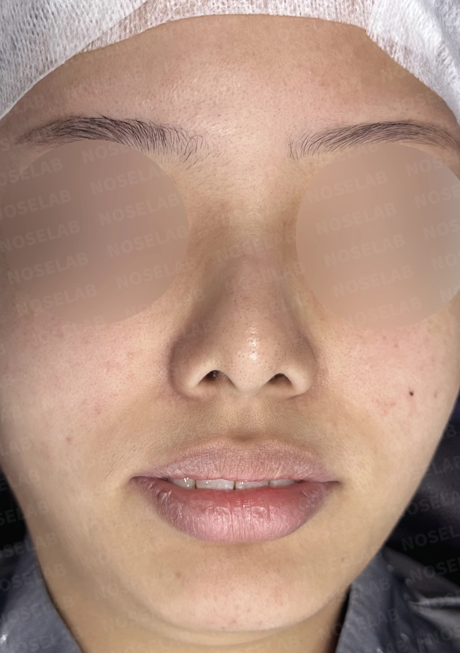 휘어진 매부리와 처진 코끝이 생기는 이유, 비중격 연장술은 어떻게 하나 — 수술 전 / 수술 직후 0일 직후 사진은 부기가 있는 상태로 최종 결과와 다를 수 있습니다.