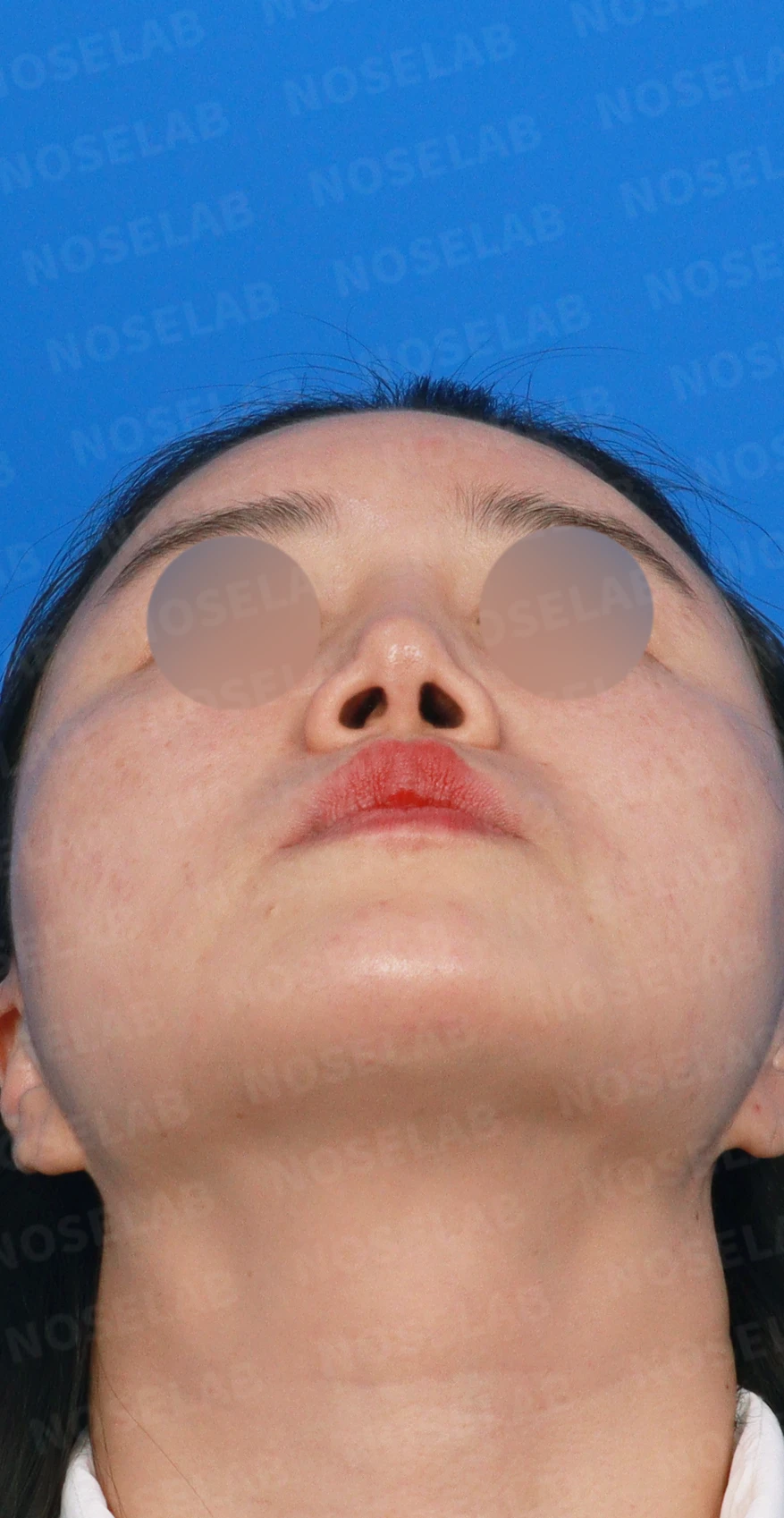 메드포어를 넣은 코에 코막힘이 생기는 이유, 제거와 자가늑연골 비중격 재건은 어떻게 하나 — 디자인 상담 우측 측면, 비스듬한 측면, 비공 사진입니다.