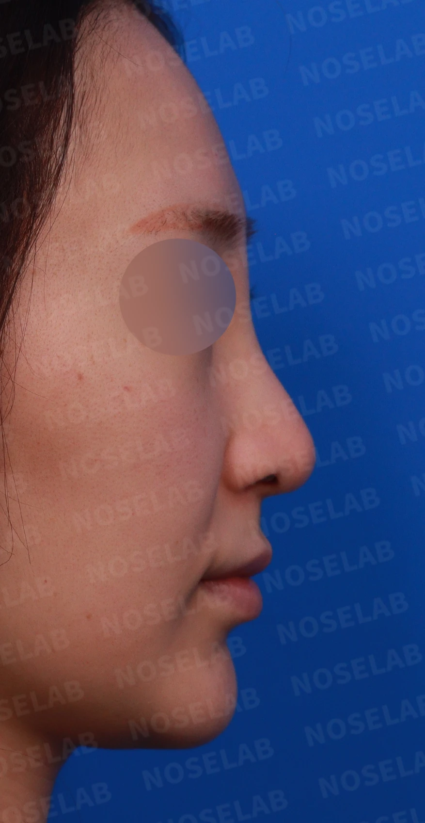 녹이지 않은 코필러가 퍼지고 축농증이 겹칠 때, 제거와 교정은 어떻게 하나 — 디자인 상담 우측 측면, 비스듬한 측면, 비공 사진