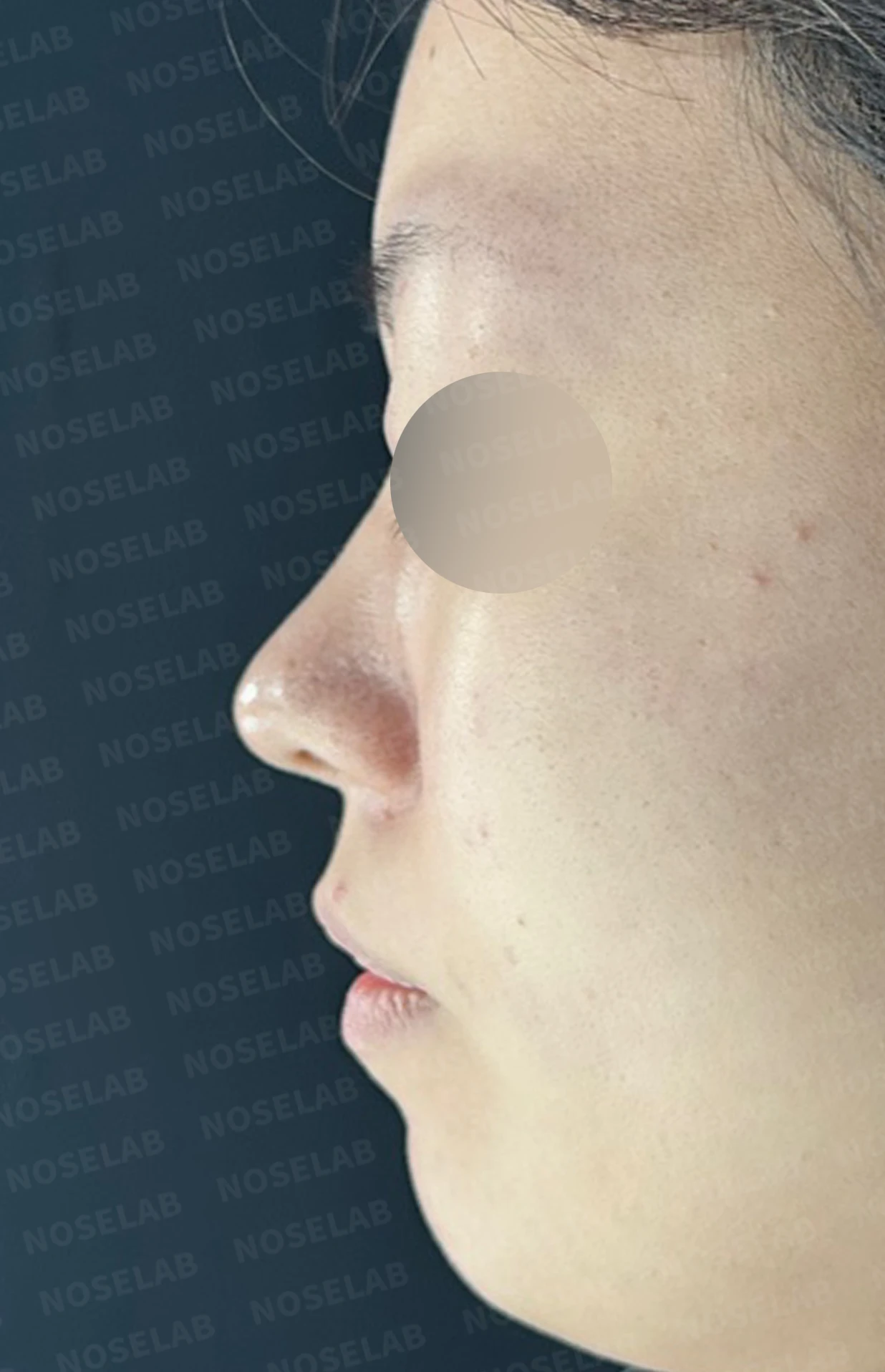 재수술 뒤에도 복코와 퍼진 코끝이 남는 이유, 자가 늑연골 재건은 어떻게 하나 — 수술 전 / 수술 직후 0일 직후 사진은 부기가 있는 상태로 최종 결과와 다를 수 있습니다.