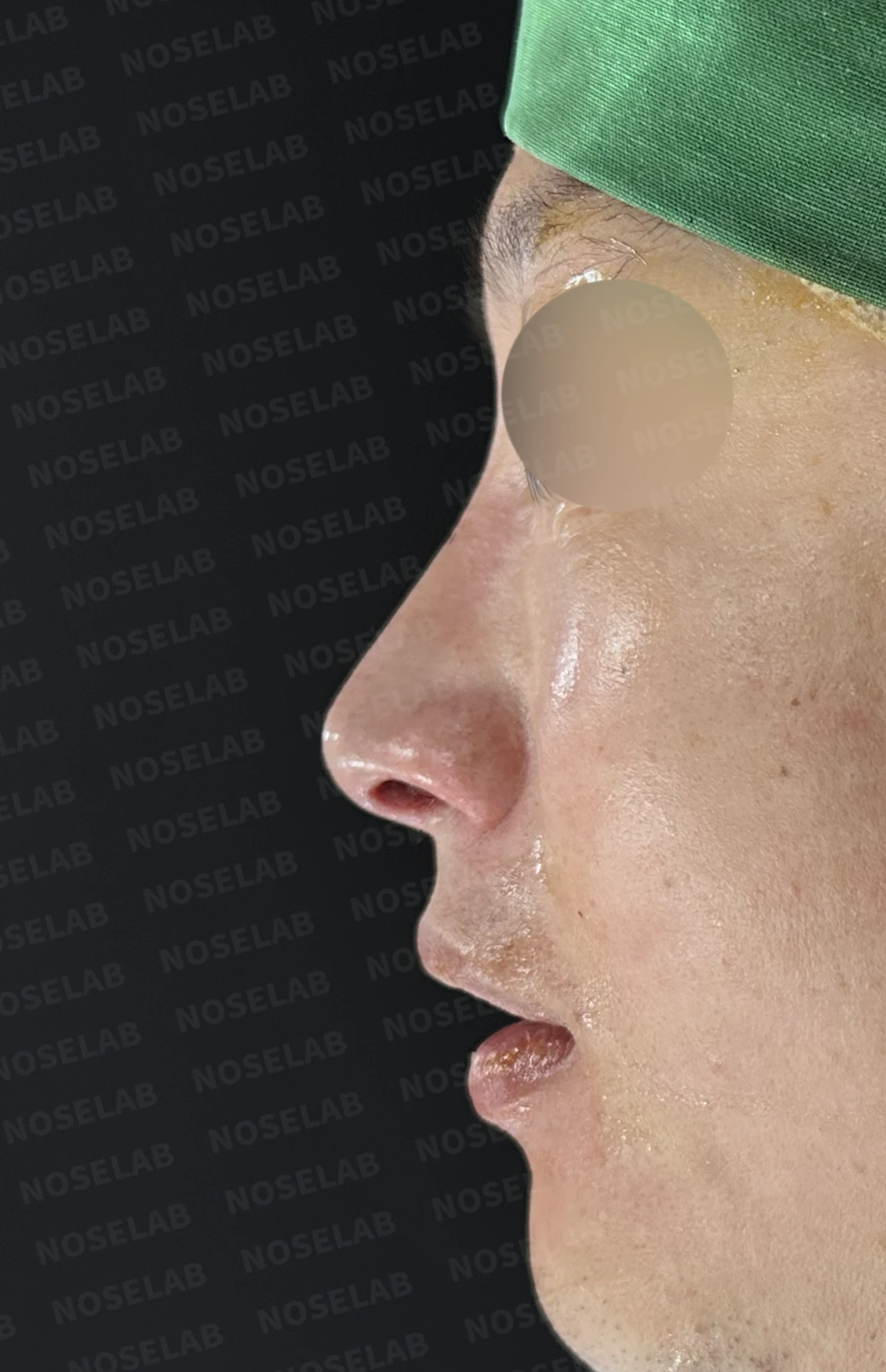 코막힘과 휘어진 비중격, 자가늑연골로 기능과 모양을 동시에 개선 — 직후 정면, 비스듬한 측면, 측면 사진입니다.