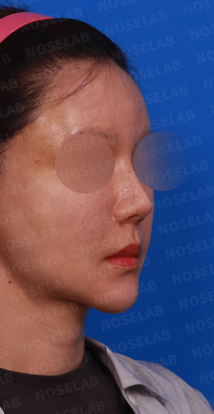 여러 차례 재수술로 코에 쓸 연골이 남지 않았을 때, 재건은 어떻게 하나 — 디자인 상담 우측 측면 , 비스듬한 측면 , 비공 사진입니다.