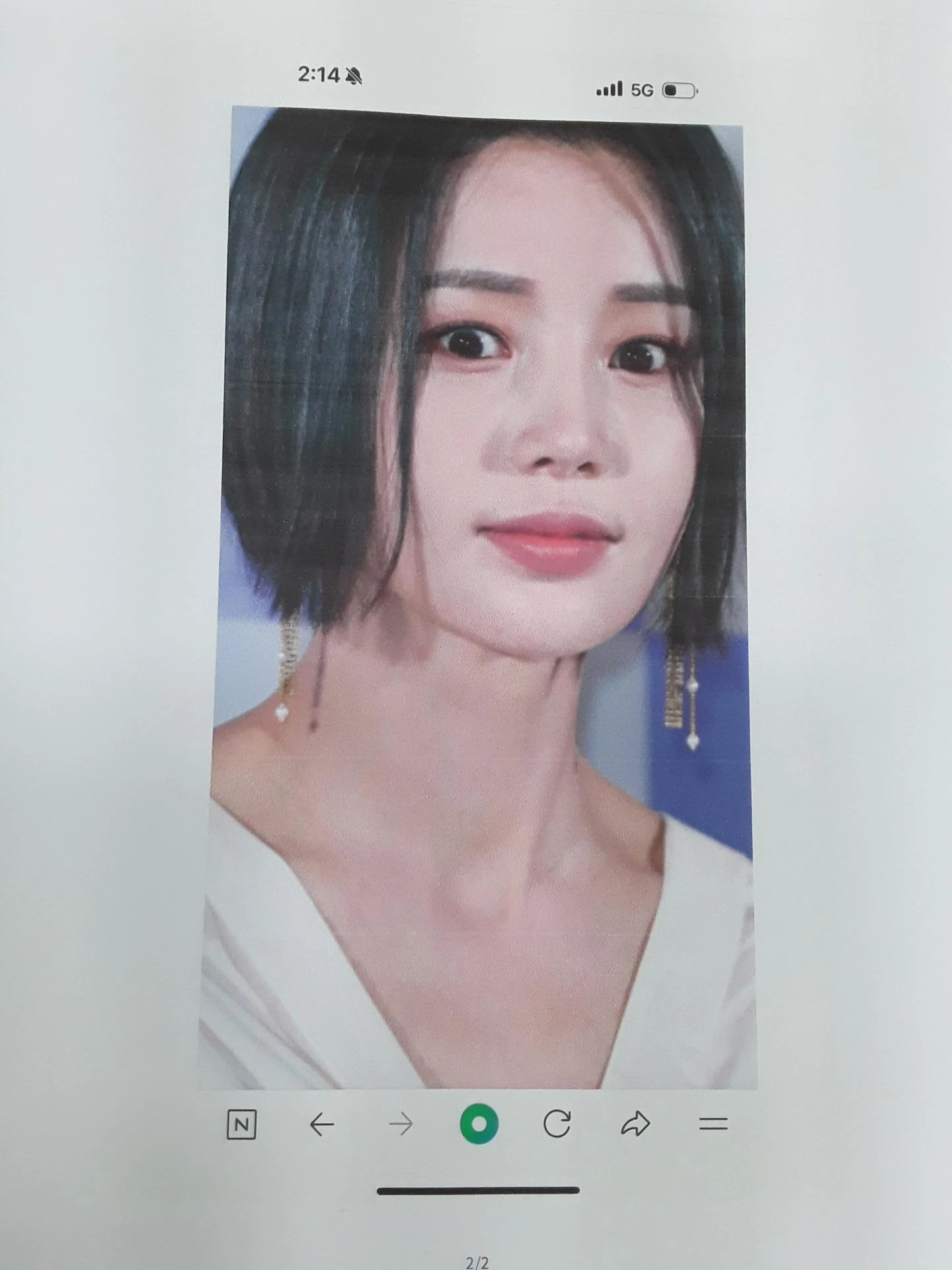 코가 들리고 콧기둥이 꺼지며 코끝이 찝혀 보이는 이유, 복합 교정은 어떻게 하나 — 본문 사진 9