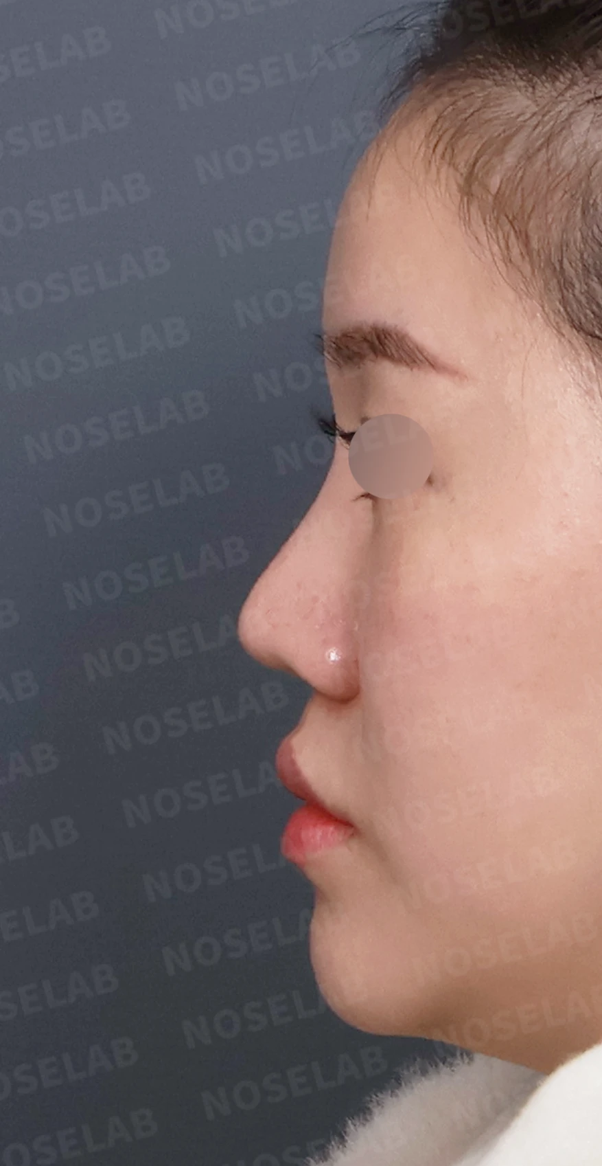 비주 함몰과 콧날개 변형, 자가늑연골을 이용한 코재수술로 자연스럽게 교정 — 디자인 상담 정면, 좌측 측면, 비스듬한 측면 사진입니다.