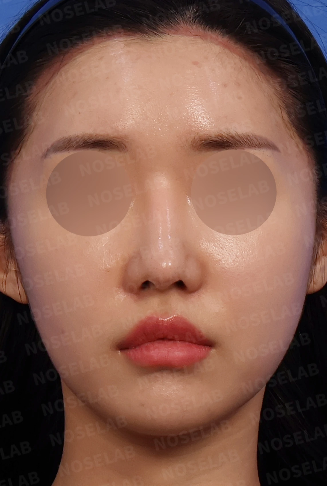 화살코와 복코가 함께 있는 코, 비중격 재건부터 시작하는 이유 — 디자인 상담 정면, 좌측 측면, 비스듬한 측면 사진입니다.