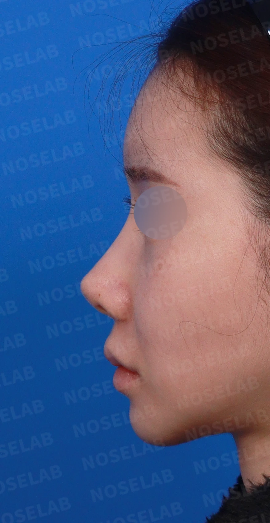 코성형 뒤 코끝이 들리고 비주가 짧아 보이는 이유, 비주 하강과 콧대 라인 교정 방법 — 디자인 상담 정면, 좌측 측면, 비스듬한 측면 사진입니다.
