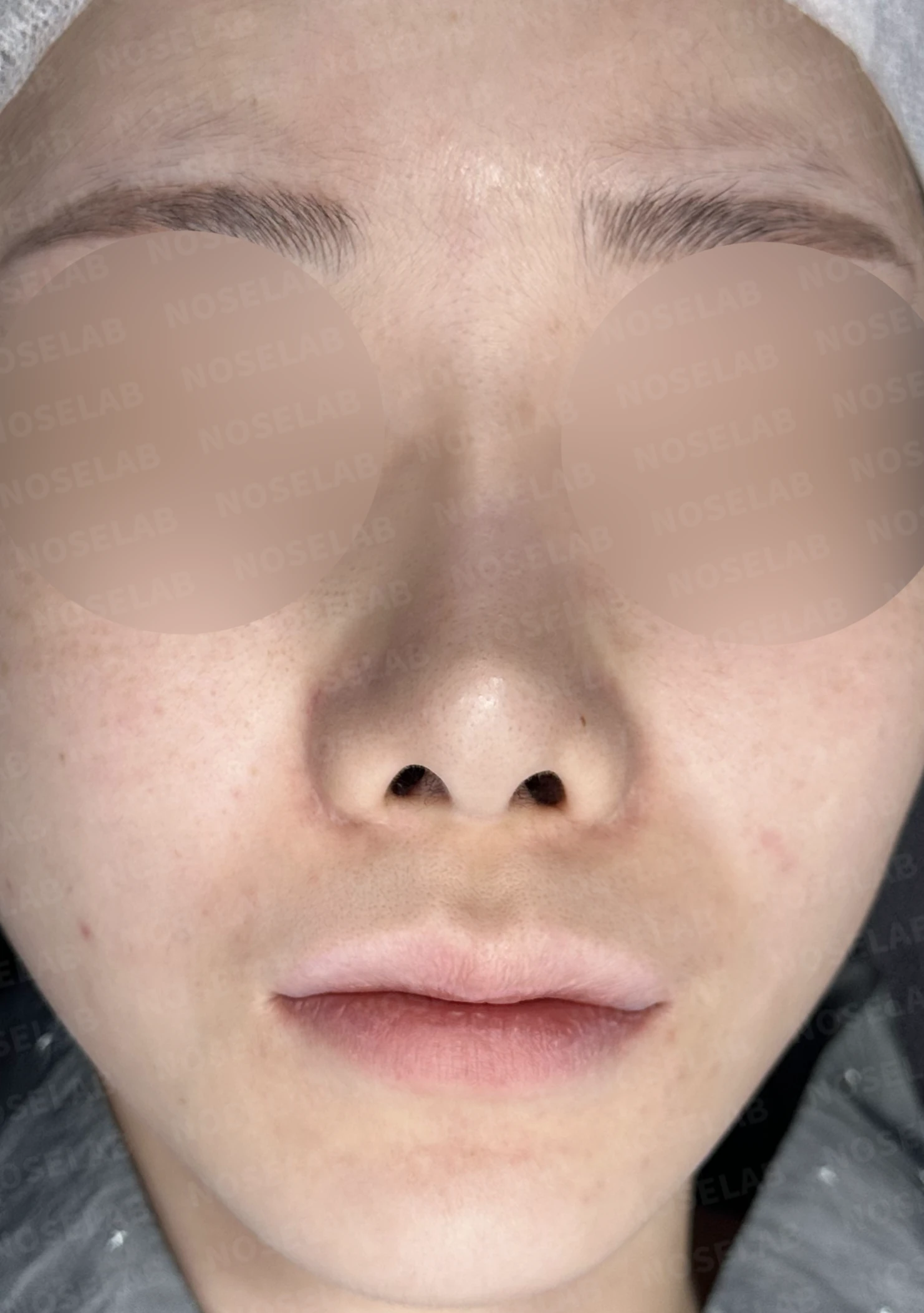 코성형 뒤 코끝이 들리고 비주가 짧아 보이는 이유, 비주 하강과 콧대 라인 교정 방법 — 수술 전 / 수술 직후 0일 직후 사진은 부기가 있는 상태로 최종 결과와 다를 수 있습니다.