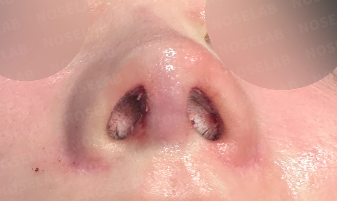코성형 후 남는 미세한 높이 부족과 좌우 비대칭, 왜 생기고 어떻게 보강하나 — 수술 전 / 수술 직후 0일 직후 사진은 부기가 있는 상태로 최종 결과와 다를 수 있습니다.