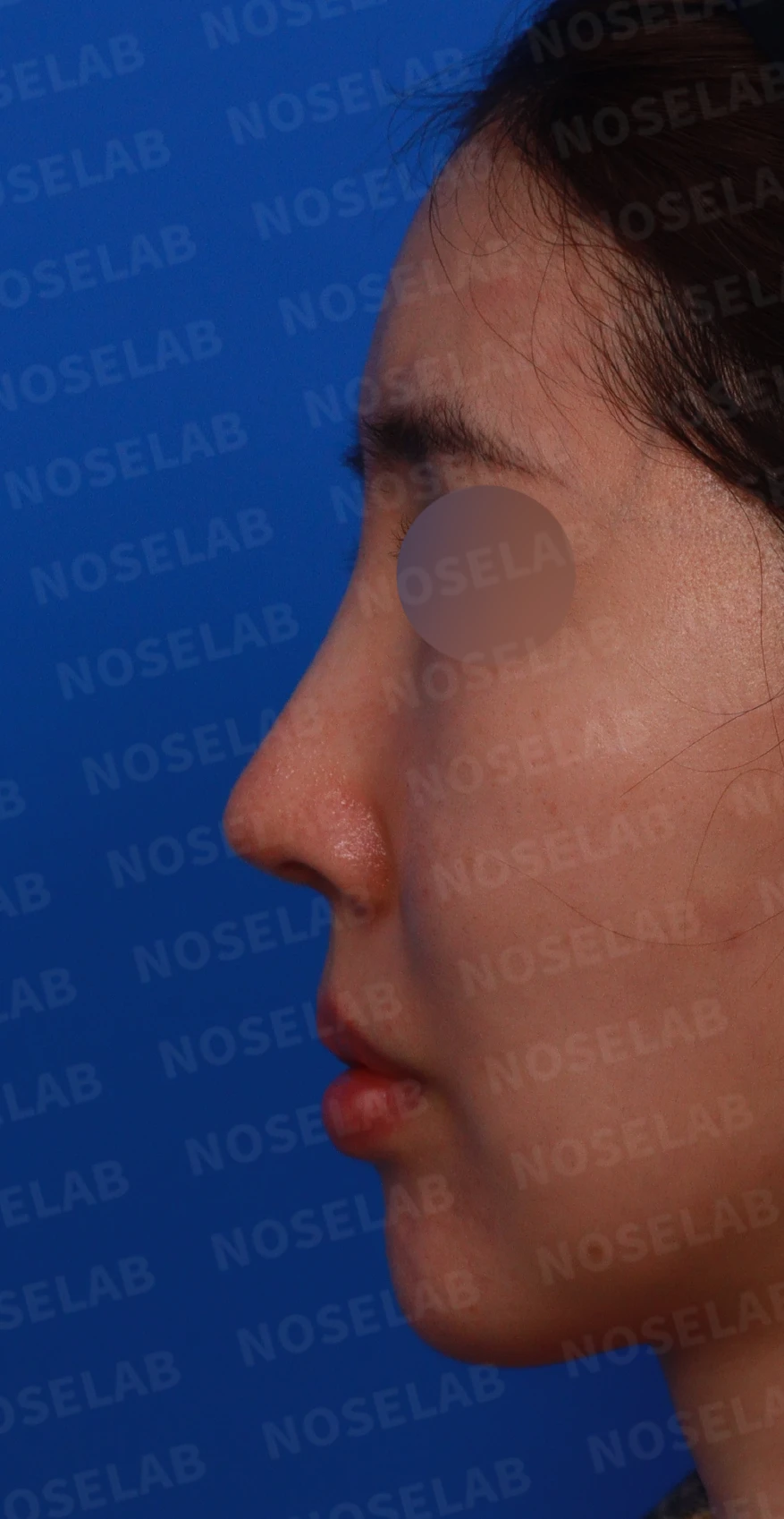 긴 코와 비대칭을 함께 교정하는 재수술 방법 — 디자인 상담 정면, 좌측 비스듬한 측면, 측면 사진