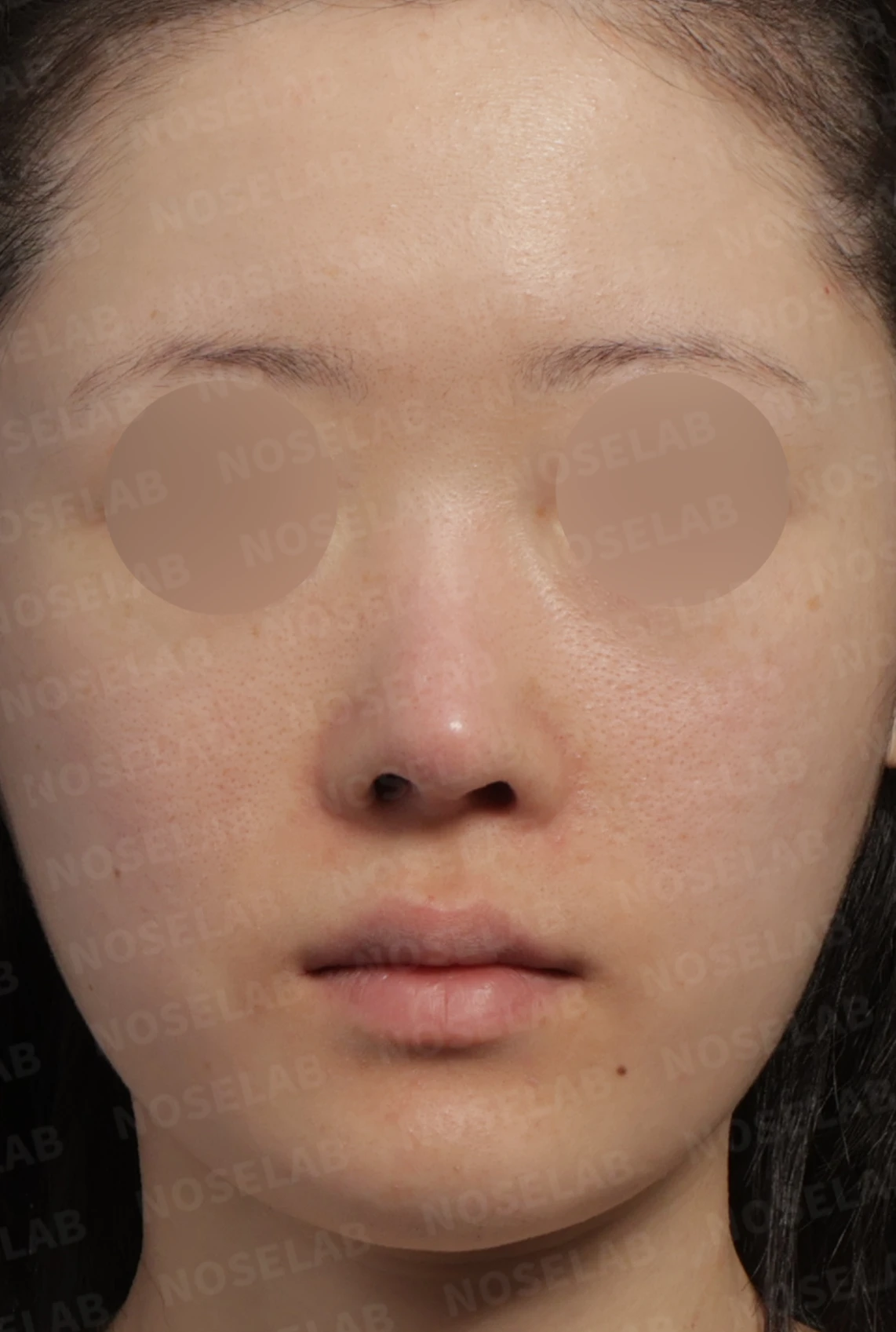 보형물 비침과 들린 코, 자가늑연골로 안전하게 교정한 코재수술 — 디자인 상담 정면 , 좌측 비스듬한 측면 , 측면 사진입니다.