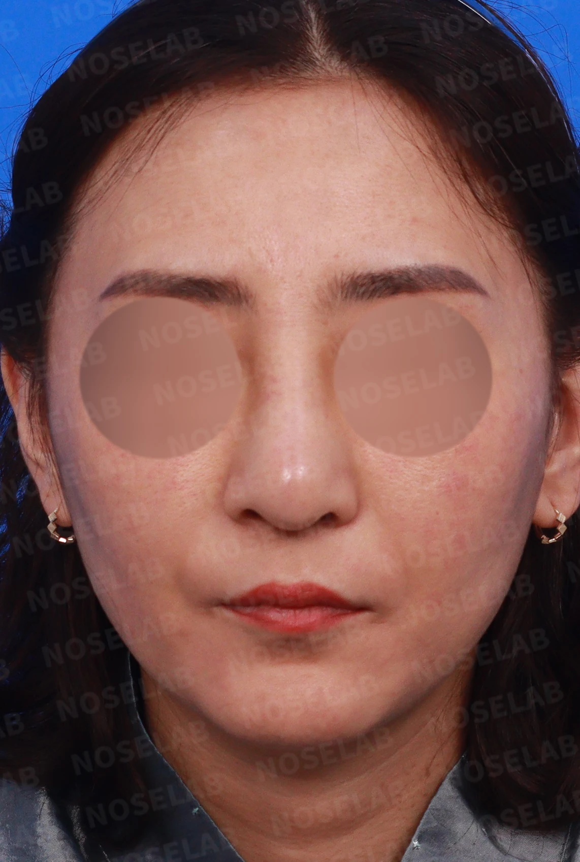 무자격 불법 주사 뒤 콧구멍이 좁아지는 이유와 제거·재건 방법 — 디자인 상담 정면, 좌측 측면, 비스듬한 측면 사진입니다.