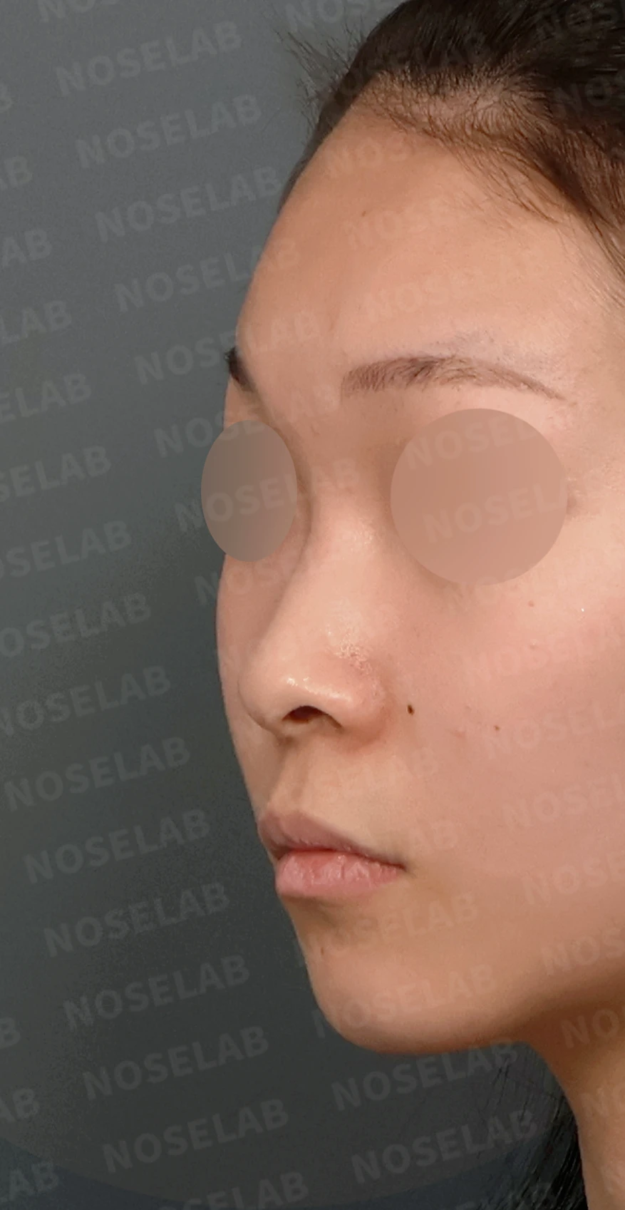 낮고 퍼진 코, 기증늑연골과 실리콘 보형물로 자연스러운 코 라인 완성 — 디자인 상담 정면, 좌측 측면, 비스듬한 측면 사진입니다.
