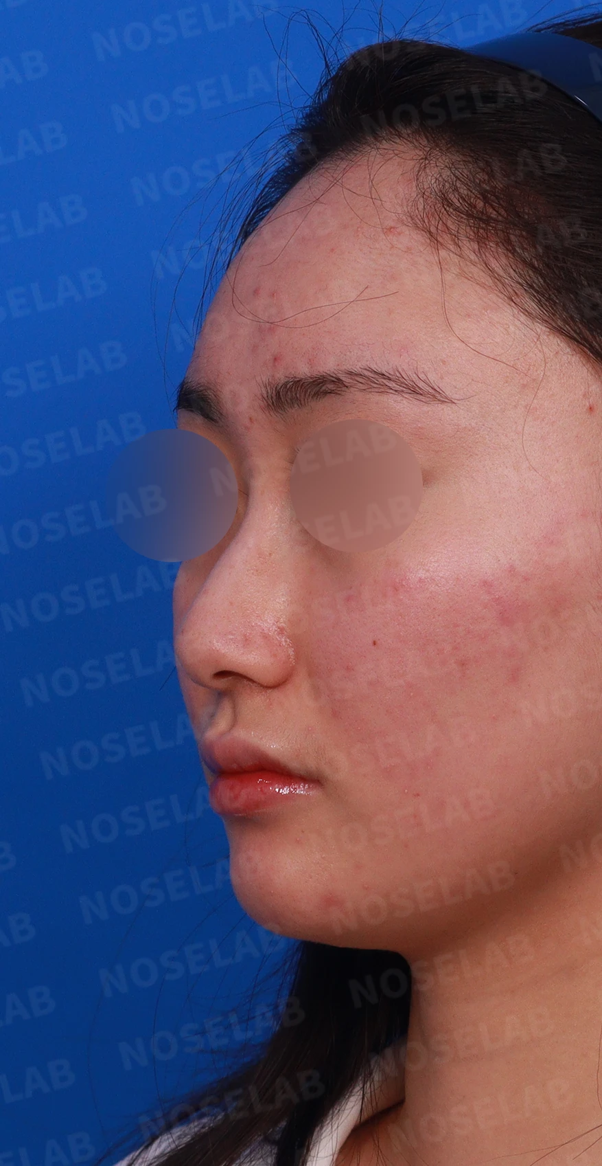 코끝이 뭉툭하게 퍼지고 코가 휘어 보이는 이유, 늑연골 재건은 어떻게 하나 — 디자인 상담 정면 , 좌측 비스듬한 측면 , 측면 사진입니다.