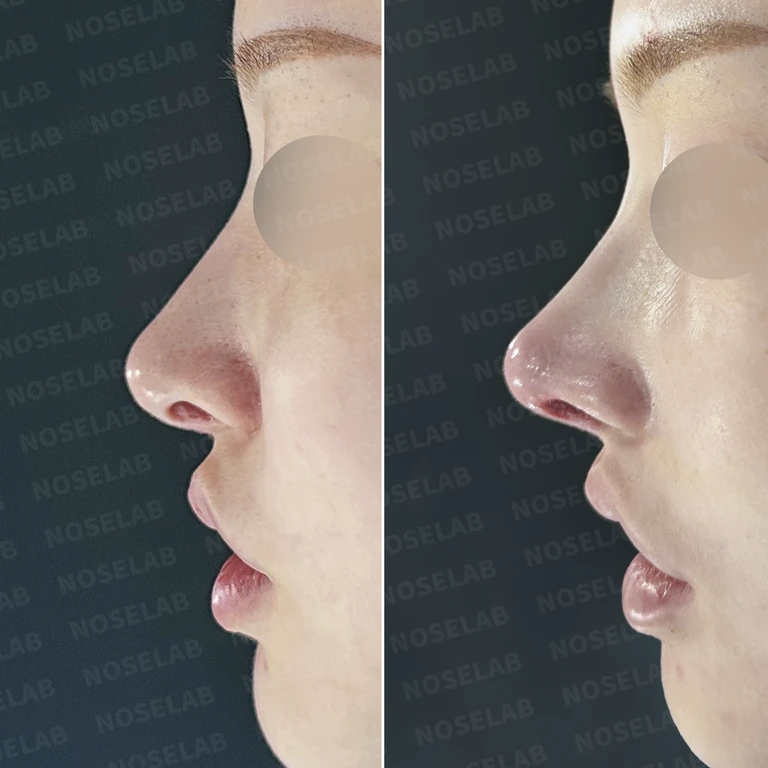휘어진 비중격 자가늑연골로 튼튼하게 재건한 코성형 — 전후 비교