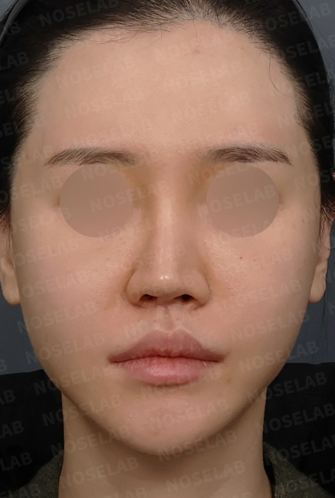 콧구멍 좌우가 심하게 달라 보이는 이유, 연골 재건과 피부이식 교정은 어떻게 하나 — 디자인 상담 정면, 좌측 측면, 비스듬한 측면 사진입니다.