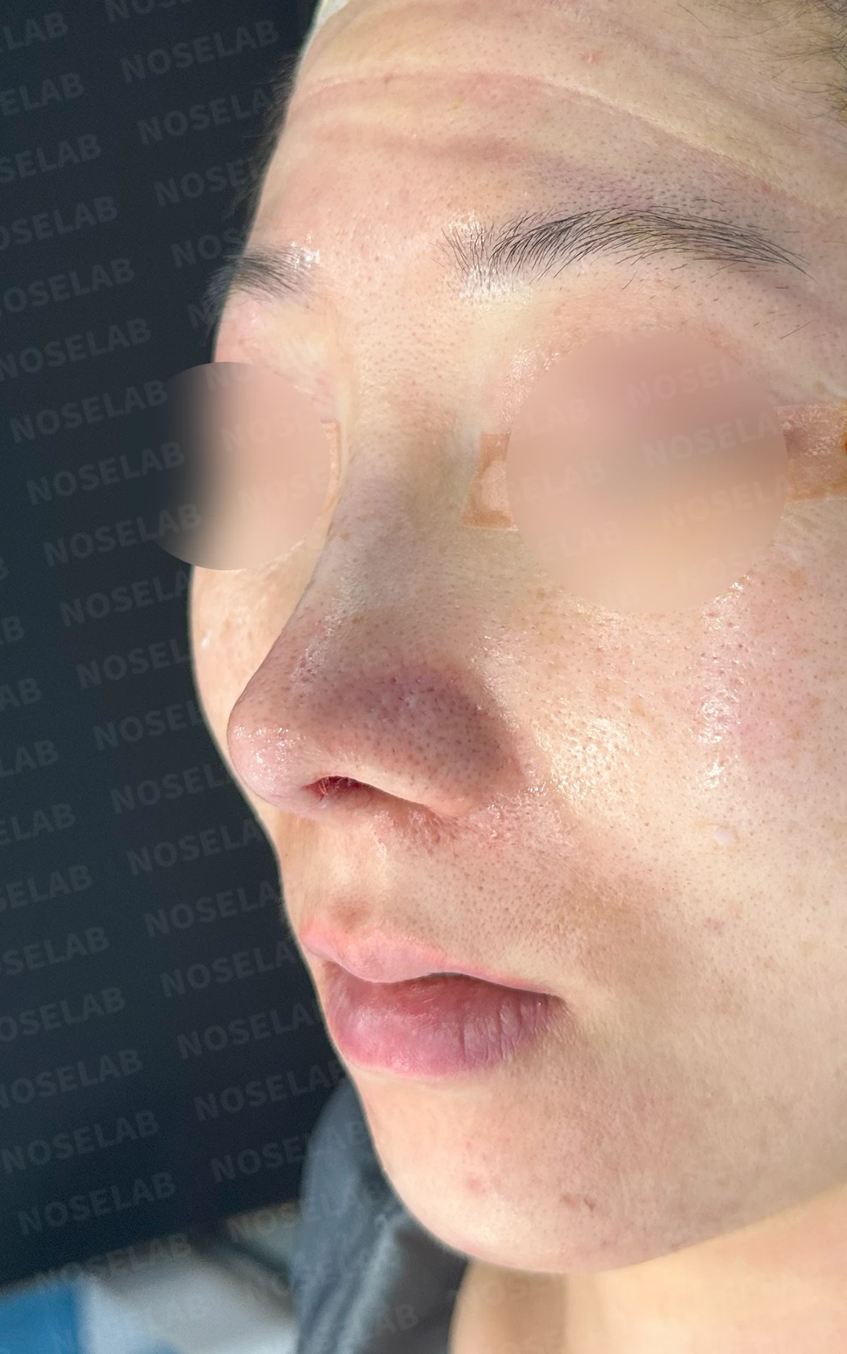 콧대 시작점이 높고 코가 휘어 보이는 이유, 자가 늑연골 교정은 어떻게 하나 — 수술 직후 0일 정면 , 비스듬한 측면 , 측면 사진입니다. 직후 사진은 부기가 있는 상태로 최종 결과와 다를 수 있습니다.