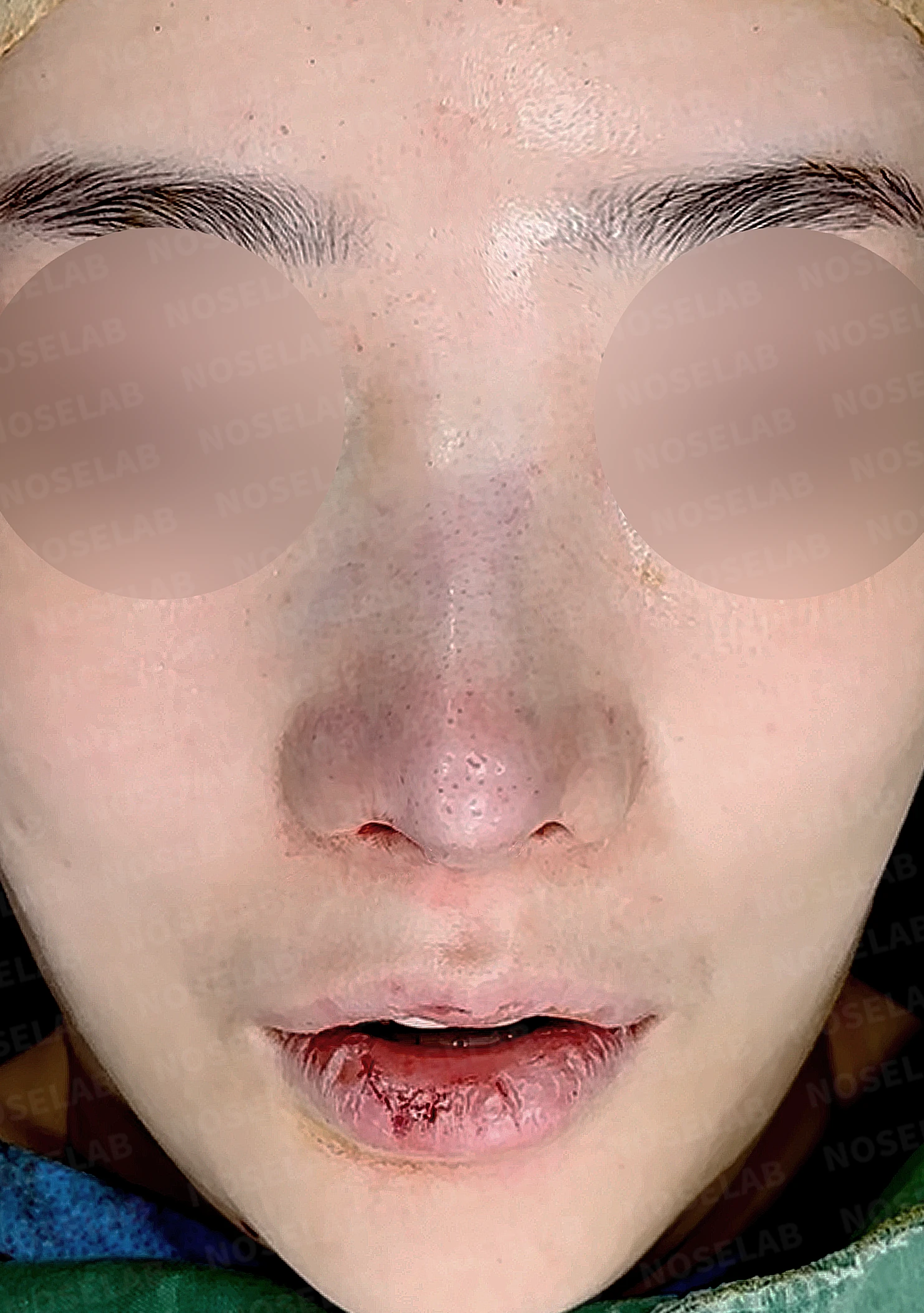 휘어진 코와 퍼진 코끝, 자가늑연골로 세련된 직반라인 완성한 코재수술 — 직후 정면, 비스듬한 측면, 측면 사진입니다.
