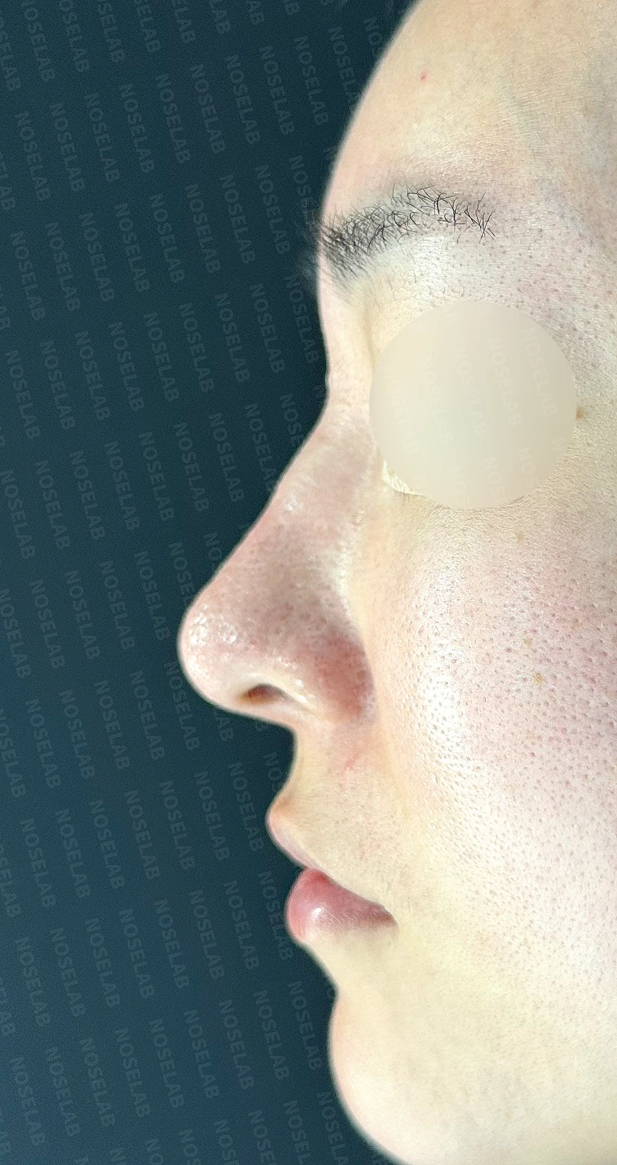 외측절골 후 코막힘과 비대칭을 살펴보는 교정 방법 — 수술 전 / 수술 직후 0일 직후 사진은 부기가 있는 상태로 최종 결과와 다를 수 있습니다.