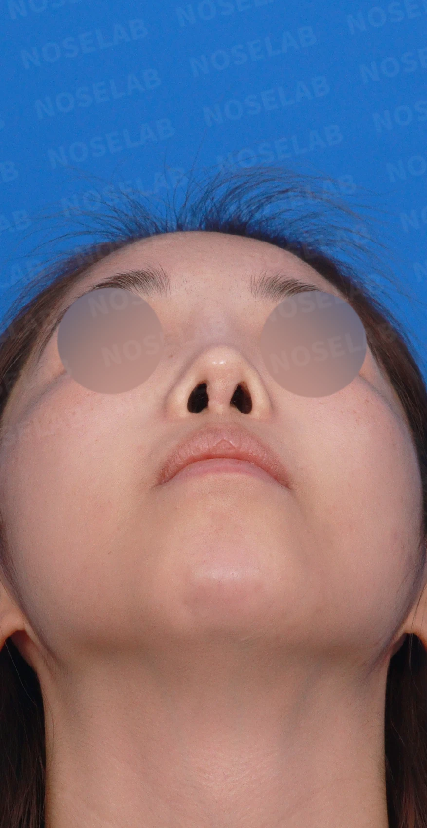 보형물을 넣고 빼기를 반복한 코에 남는 콧등 패임과 들린 느낌 — 디자인 상담 우측 비스듬한 측면 , 측면 , 비공 사진입니다.