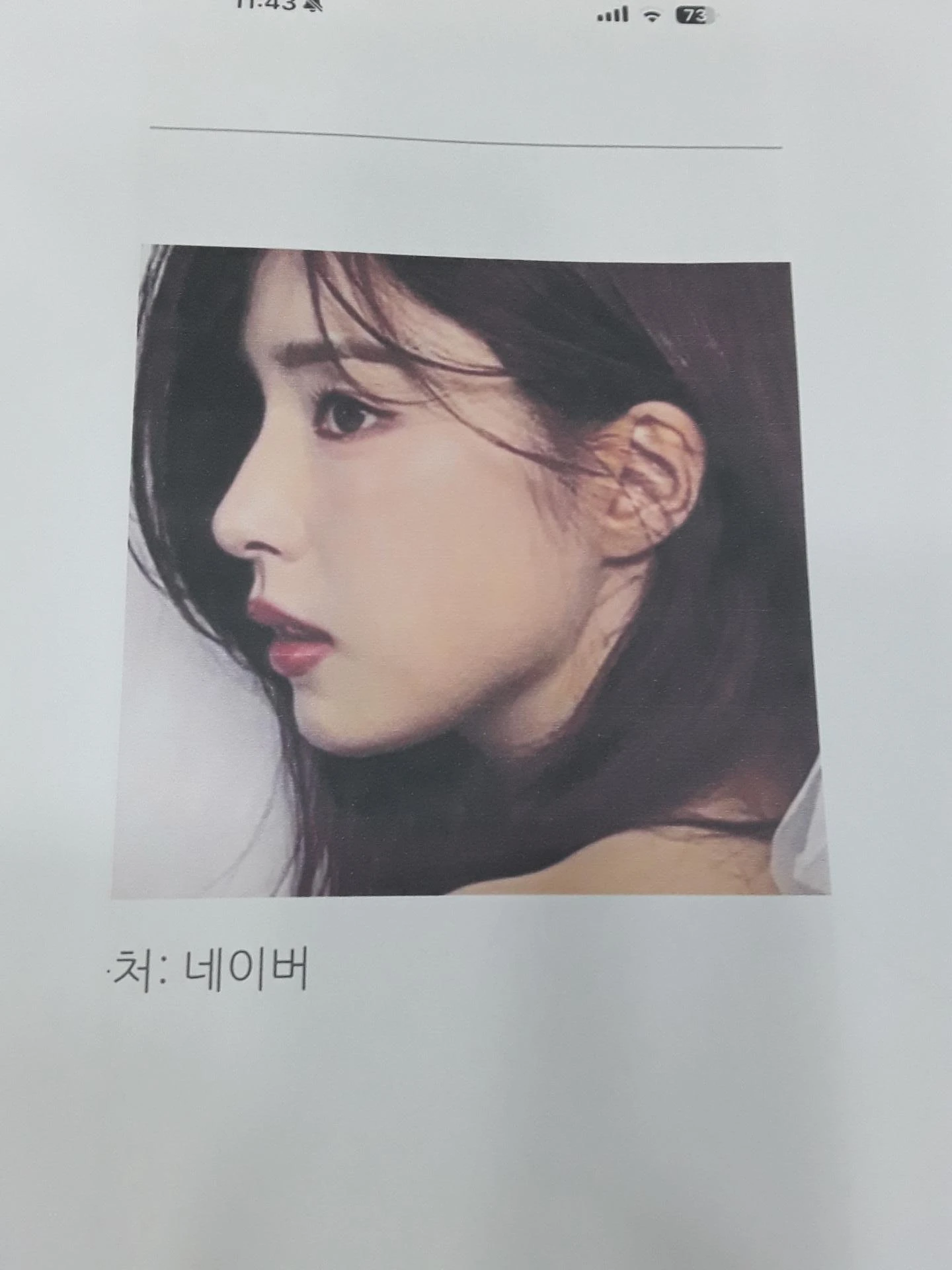 비중격 연골이 약해진 코, 보형물 없이 재건하는 방법 — 본문 사진 9