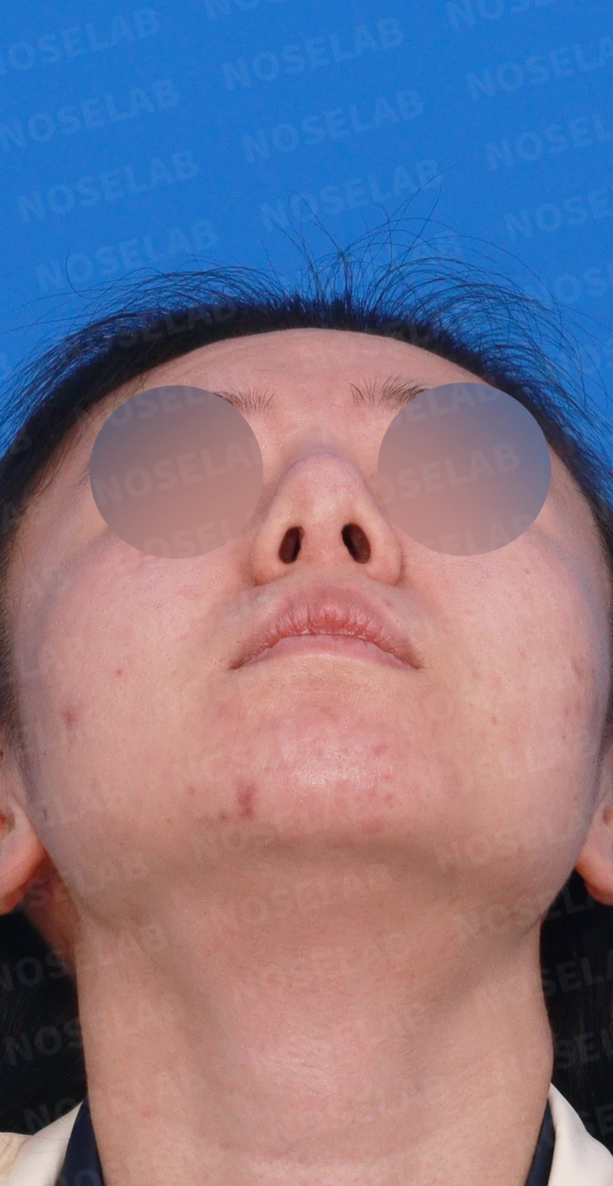 이전 수술 뒤 코가 딱딱해지고 짧아지는 구축, 왜 생기고 어떻게 재건하나 — 디자인 상담 우측 측면, 비스듬한 측면, 비공 사진입니다.
