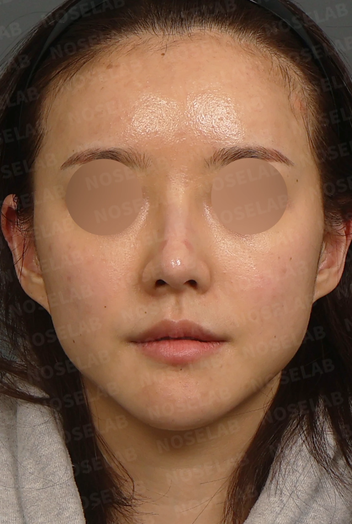 길고 처진 코끝과 코막힘, 자가늑연골로 자연스럽게 교정한 코재수술 — 디자인 상담 정면 / 좌측 측면 / 비스듬한 측면
