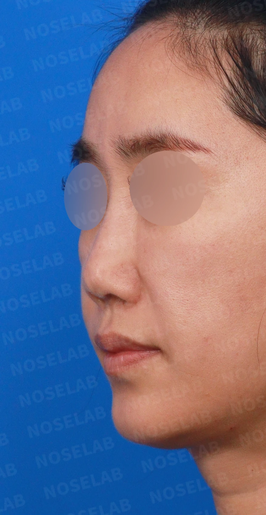 콧대에 주입한 불법 시술 이물질, 제거와 비중격 전체 재건은 어떻게 하나 — 디자인 상담 정면, 좌측 비스듬한 측면, 측면 사진입니다.