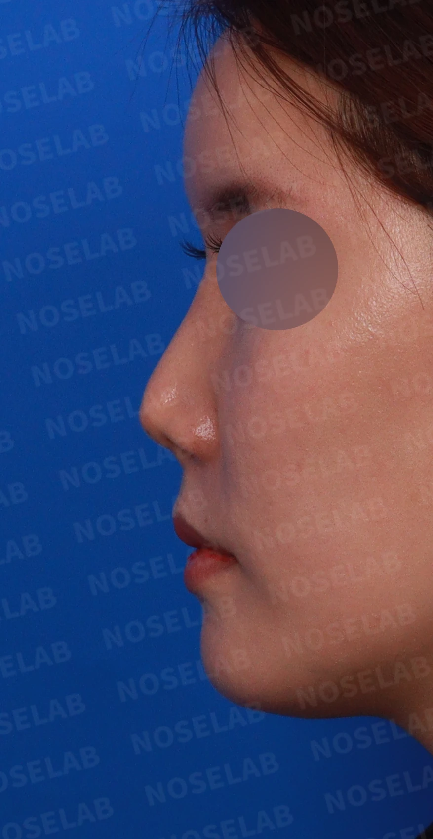 기증 늑연골이 흡수되면 코가 어떻게 변하고, 자가 늑연골 재건은 어떻게 하나 — 디자인 상담 정면 , 비스듬한 측면 사진, 좌측 측면