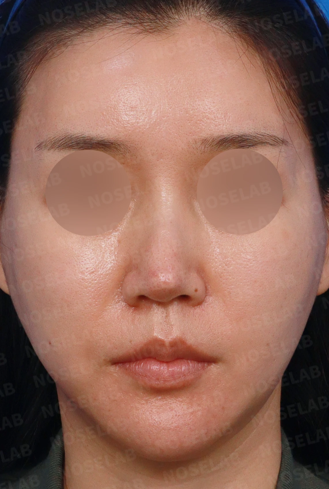 영구 필러가 코 모양을 바꾸는 과정과 제거 후 재건 방법 — 디자인 상담 정면, 좌측 측면, 비스듬한 측면 사진입니다.