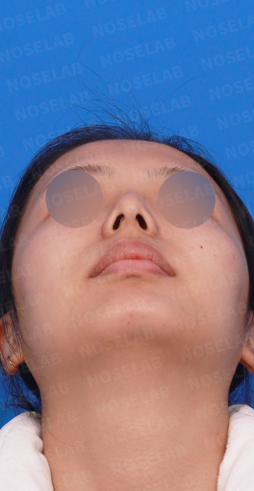 휘어진 매부리와 처진 코끝이 생기는 이유, 비중격 연장술은 어떻게 하나 — 디자인 상담 우측 측면, 비스듬한 측면, 비공 사진입니다.