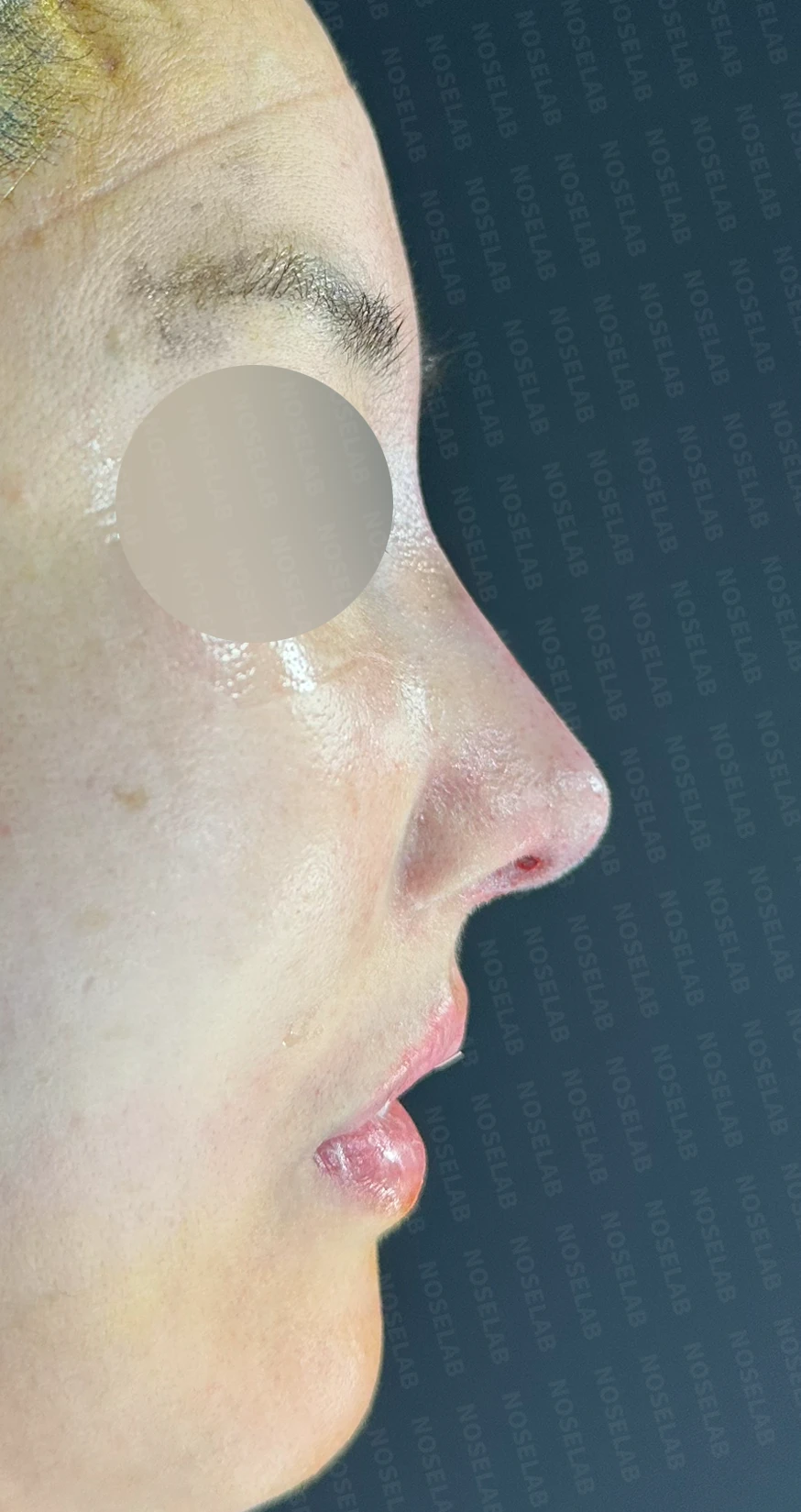 긴 코와 비대칭을 함께 교정하는 재수술 방법 — 수술 직후 0일 정면, 측면, 비스듬한 측면 사진 직후 사진은 부기가 있는 상태로 최종 결과와 다를 수 있습니다.