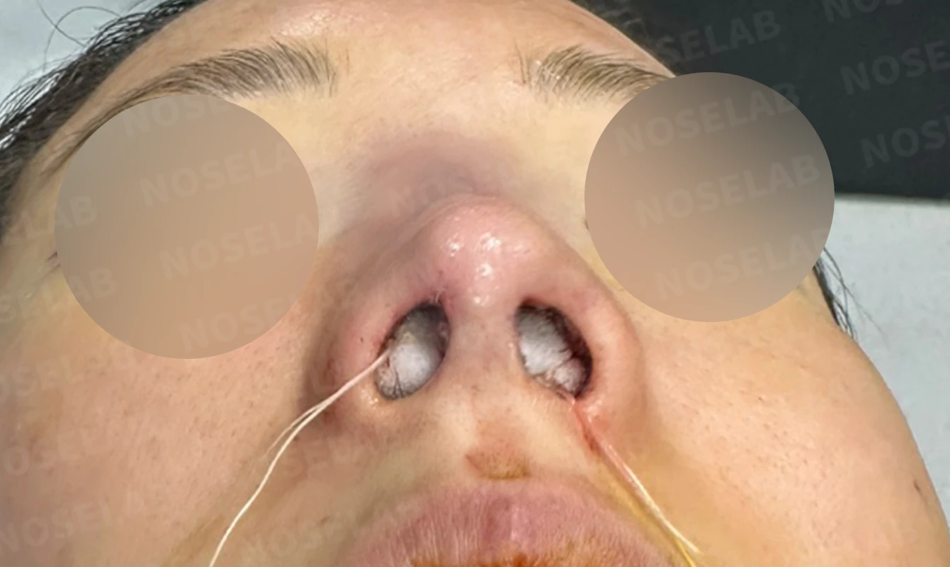코 필러 뒤에도 휜 코와 코막힘이 남는 이유, 교정은 어떻게 하나 — 수술 직후 0일 비공 사진 직후 사진은 부기가 있는 상태로 최종 결과와 다를 수 있습니다.