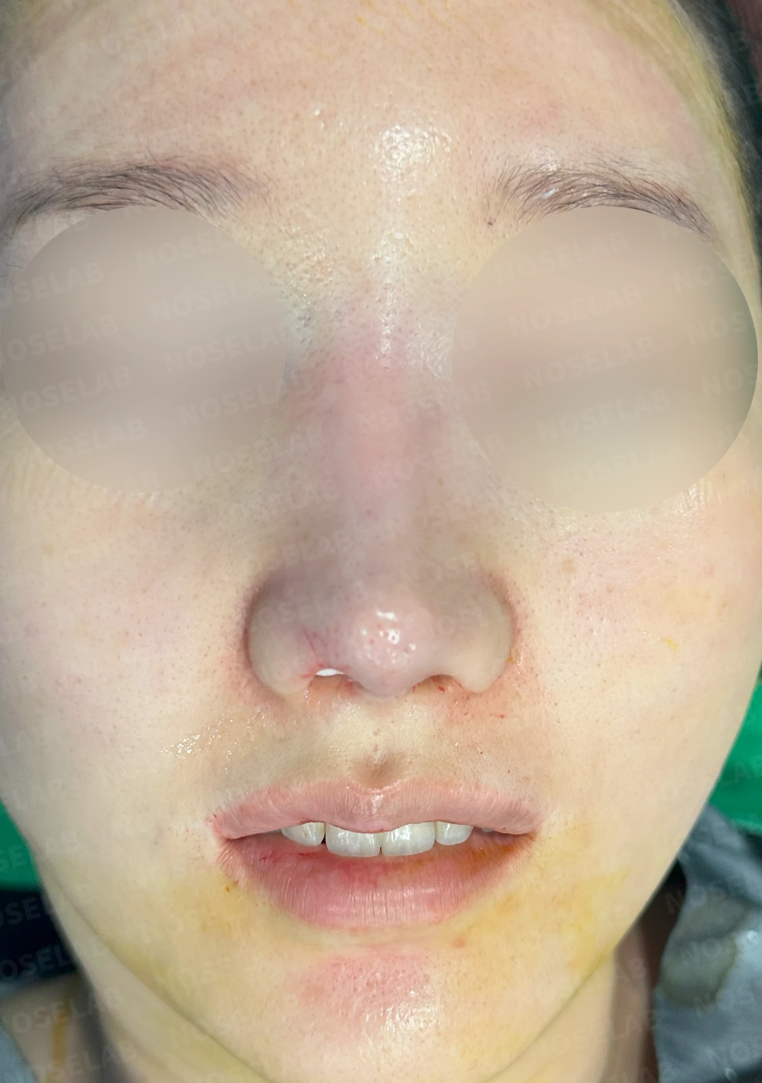 비공 비대칭과 코끝 처짐은 왜 생기나, 연골을 병용한 재건 방법 — 수술 전 / 수술 직후 0일 직후 사진은 부기가 있는 상태로 최종 결과와 다를 수 있습니다.