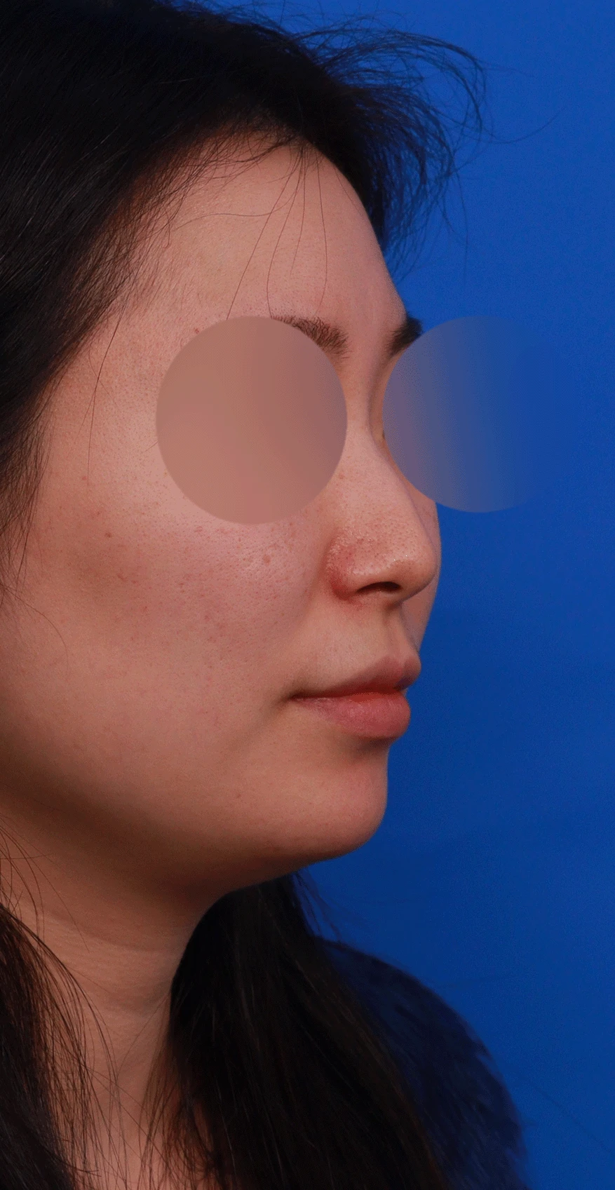 매부리코와 휜 코에 코막힘이 함께 오는 이유, 복합 교정은 어떻게 하나 — 디자인 비스듬한 측면, 측면, 비공 사진입니다.