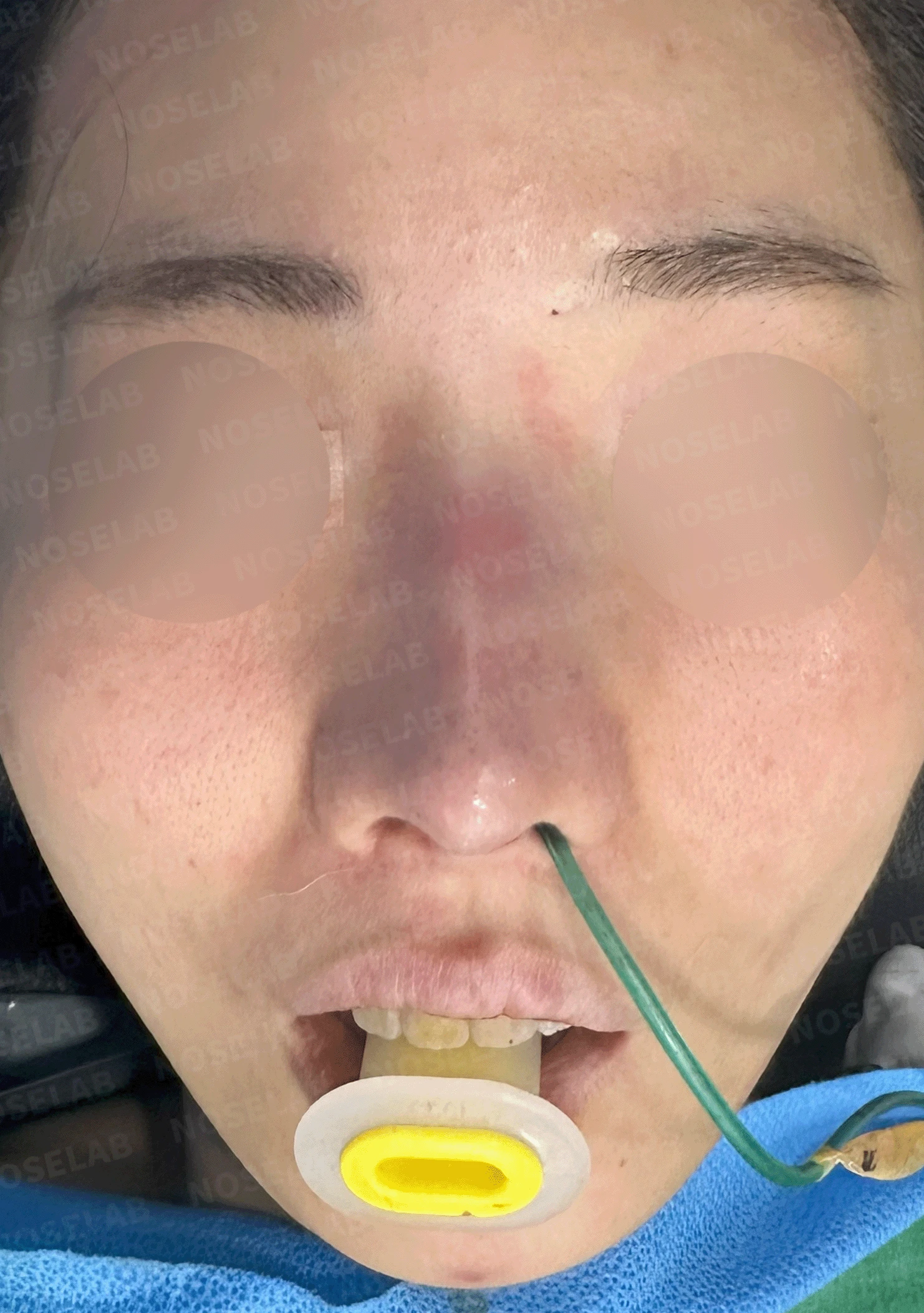 코성형 절골 후 콧등이 꺼지고 한쪽이 막히는 이유, 비밸브 재건과 복원 — 본문 사진 10