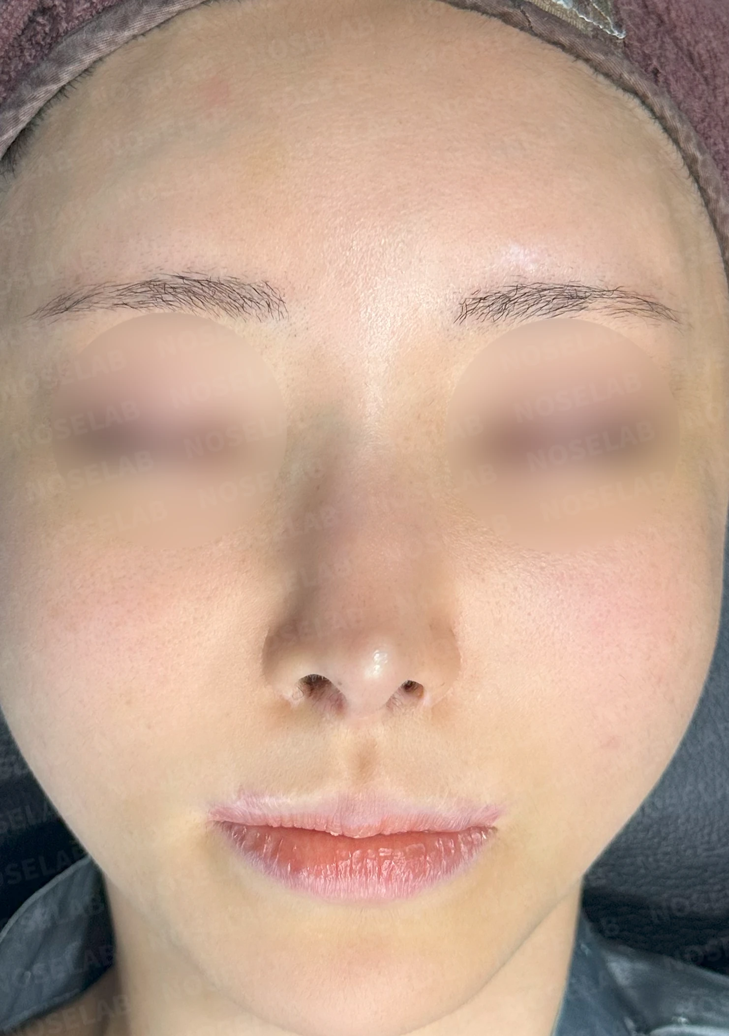 뾰족한 코끝과 연골 비침의 교정 방법 — 전(좌) 정면 사진, 전(우) 코끝 연골 비춤(화살표)
