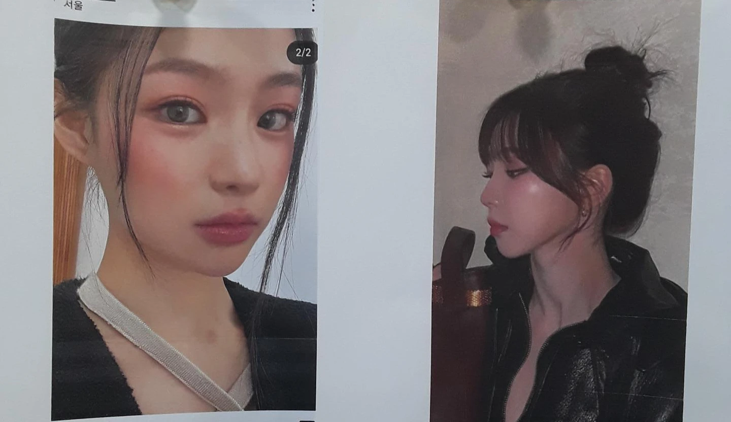 콧대가 뭉툭하게 퍼져 보이는 만성 이물 반응, 원인과 재건 방법 — 본문 사진 7