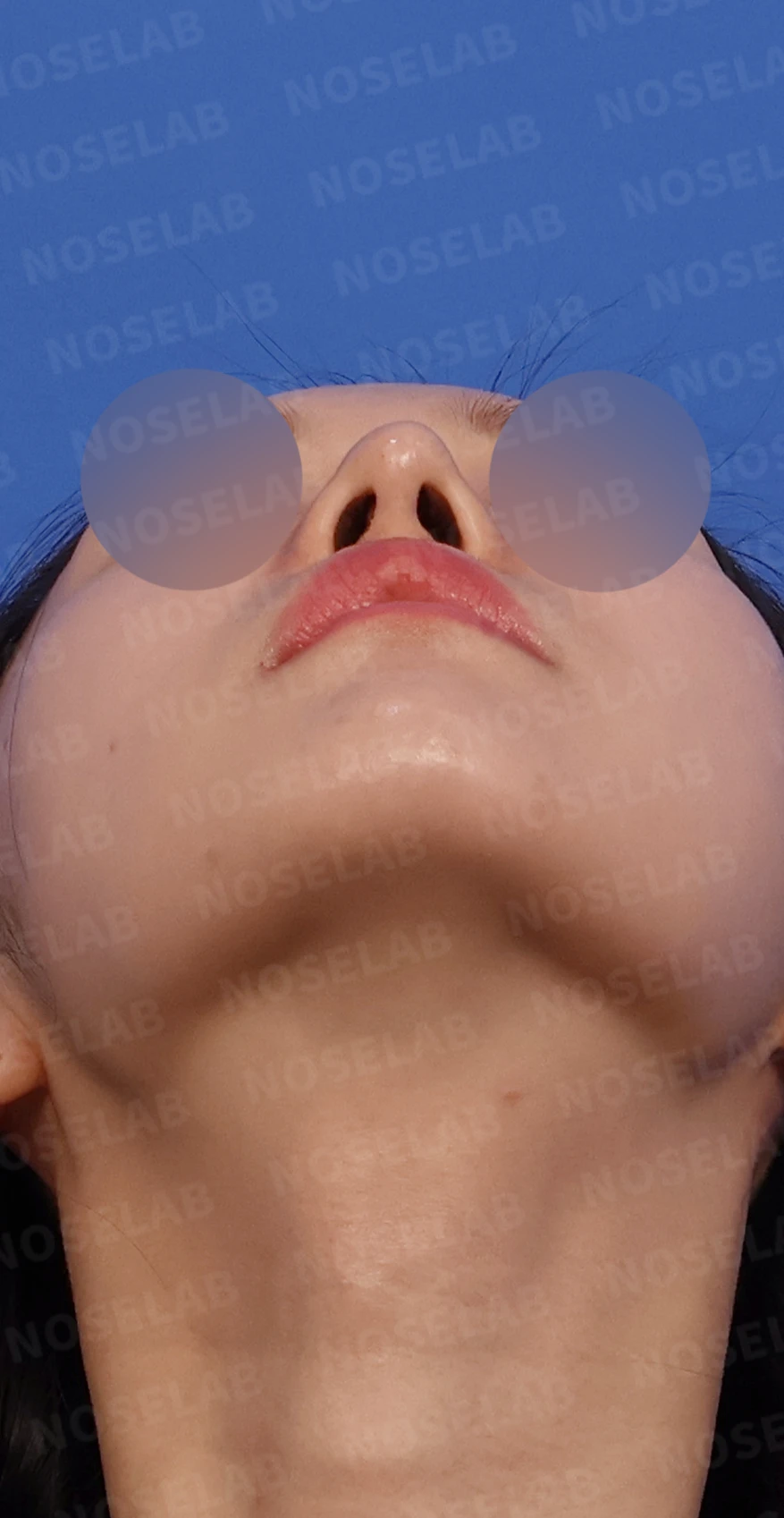 화살코와 복코가 함께 있는 코, 비중격 재건부터 시작하는 이유 — 디자인 상담 우측 측면, 비스듬한 측면, 비공 사진입니다.