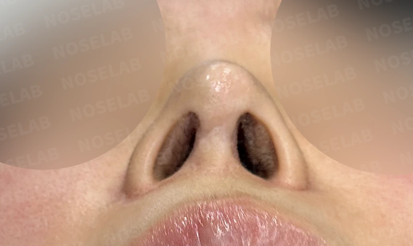 여러 차례 수술 뒤 코막힘이 남는 이유, 비중격과 비밸브 재건은 어떻게 하나 — 수술 전 / 수술 직후 0일 직후 사진은 부기가 있는 상태로 최종 결과와 다를 수 있습니다.